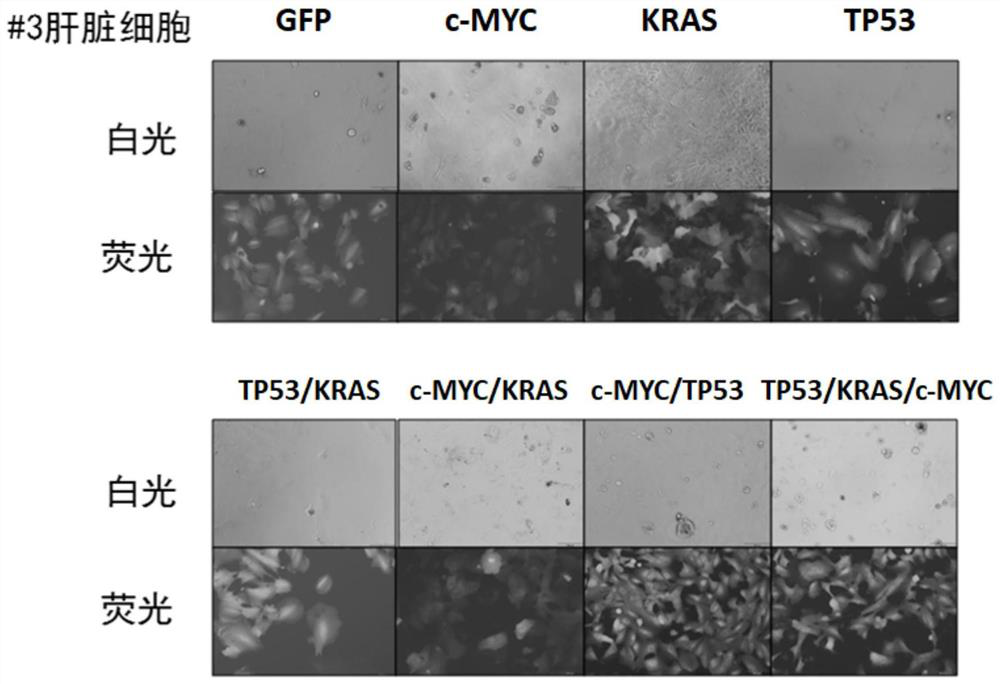 Gene combination for inducing hepatocytes into live cancer cells and application of gene combination