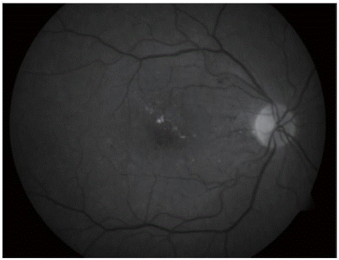 Diffusate detection method of retina fundus image