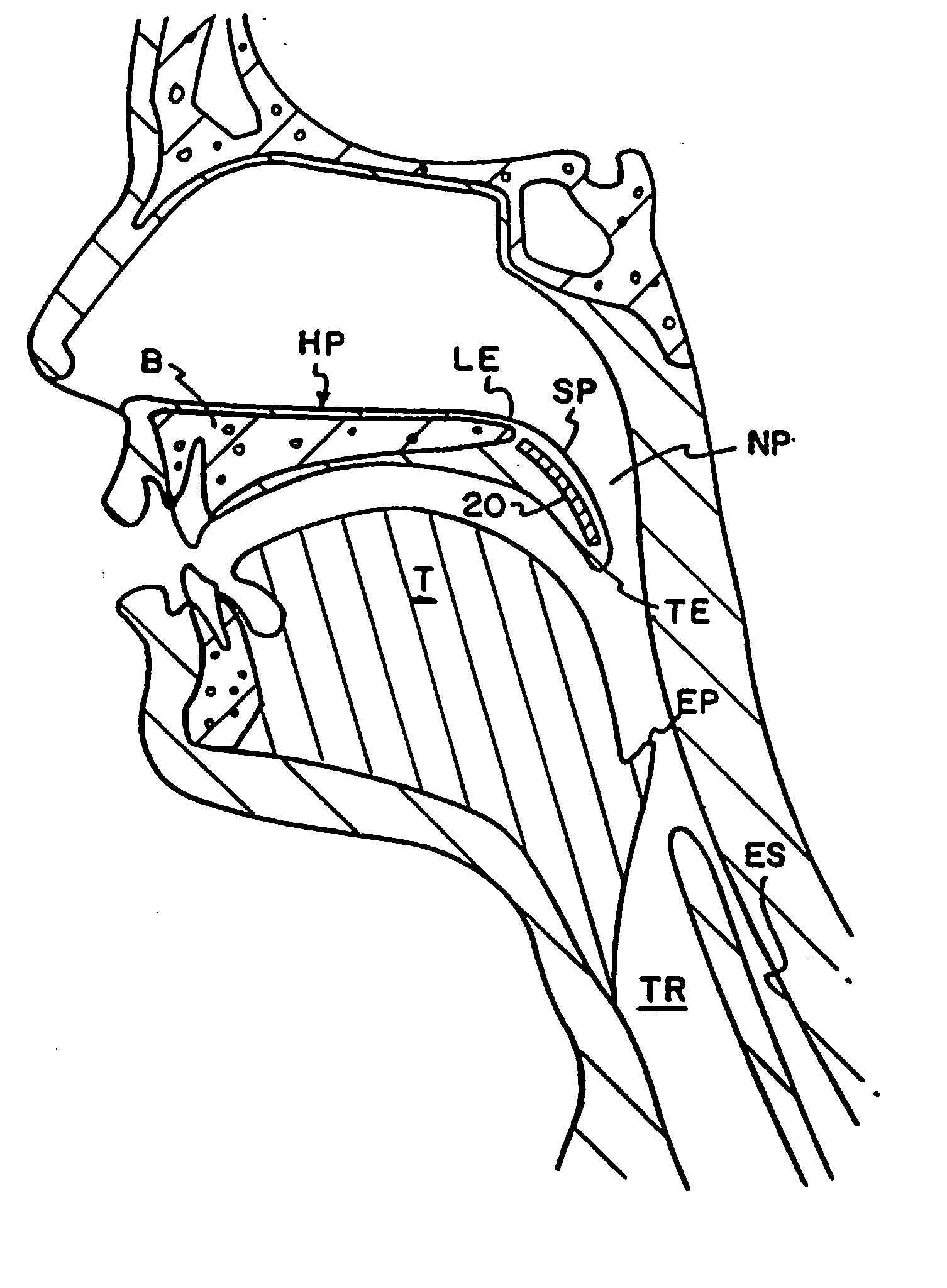 Braided implant for snoring treatment