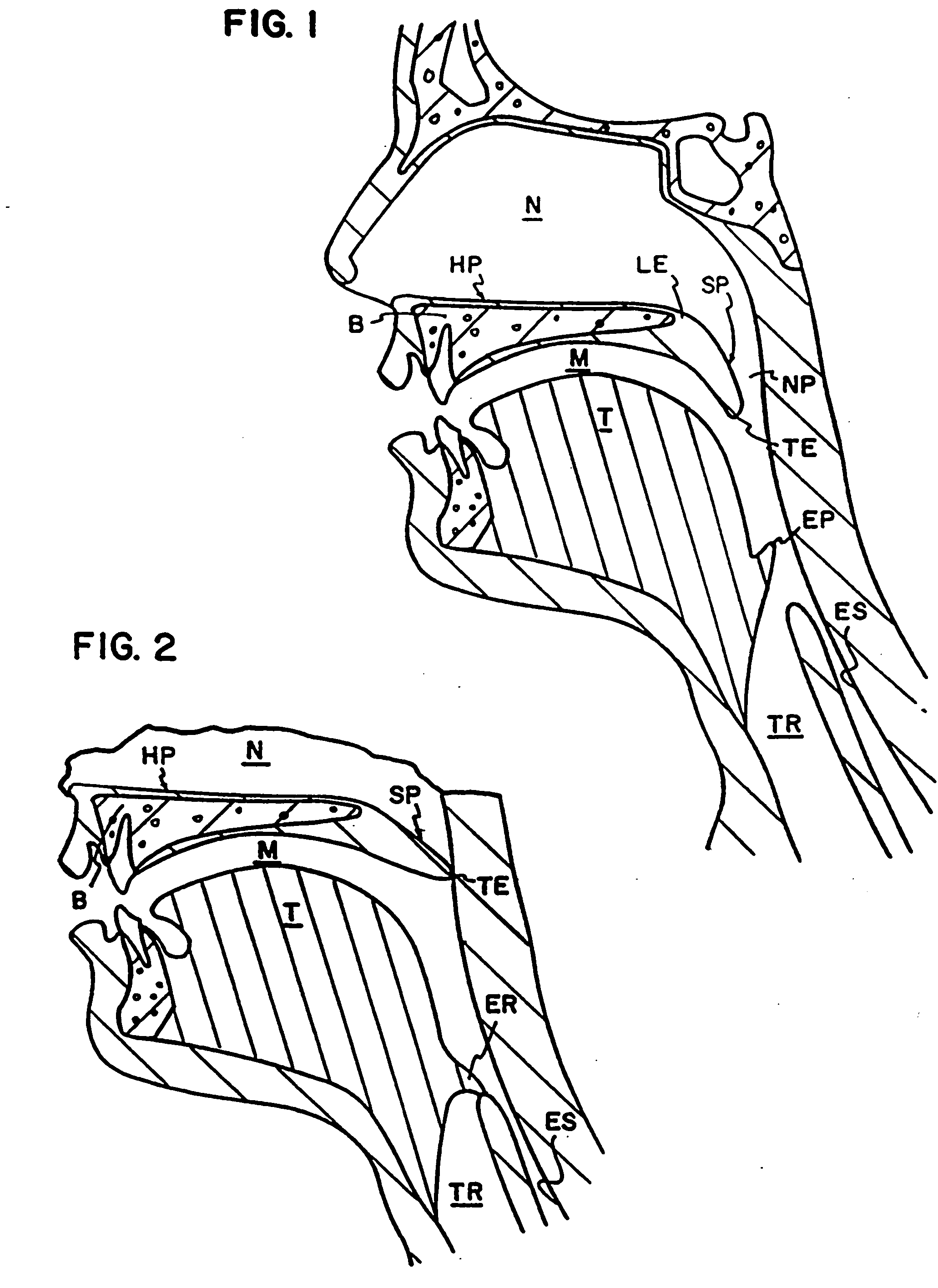 Braided implant for snoring treatment