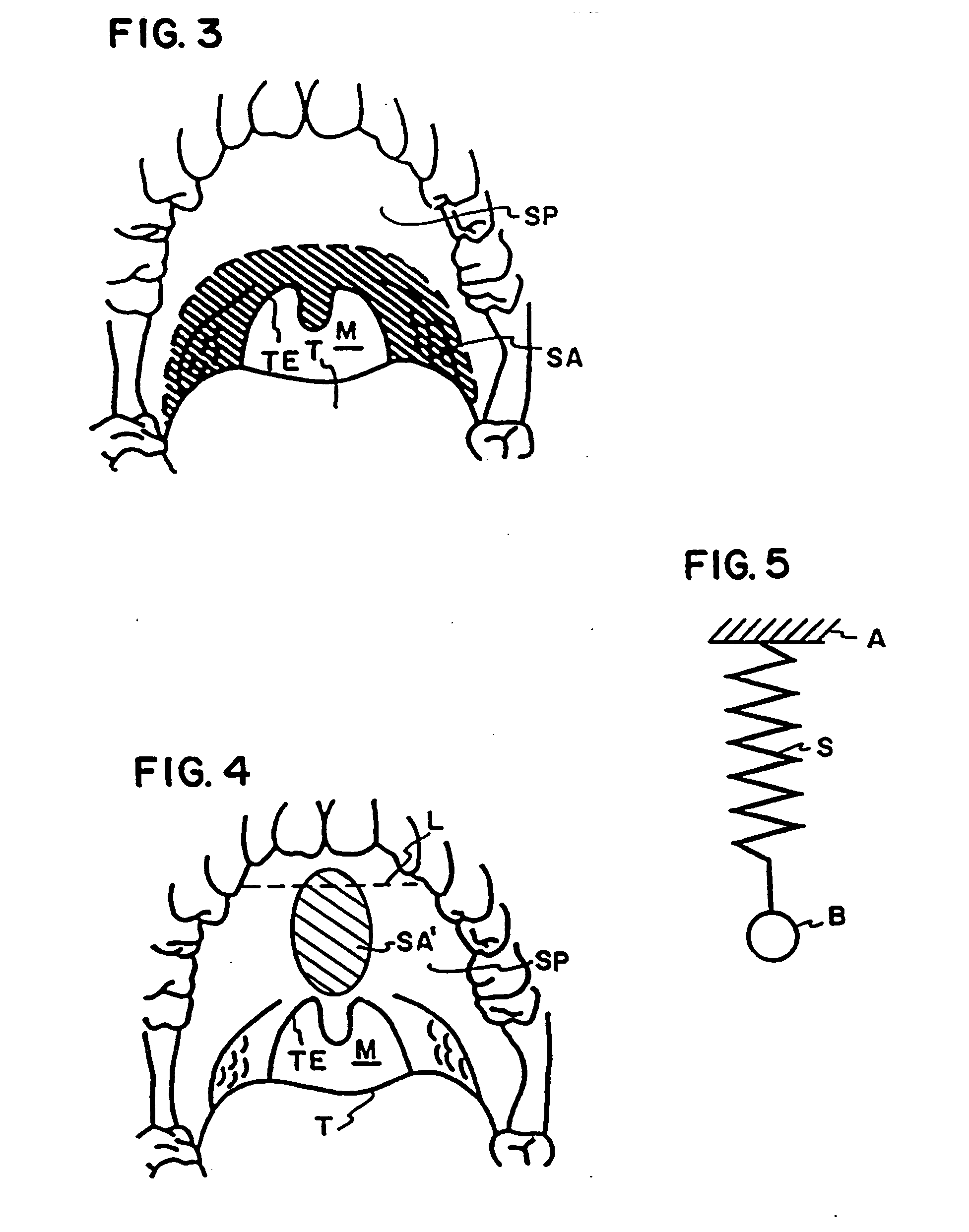 Braided implant for snoring treatment