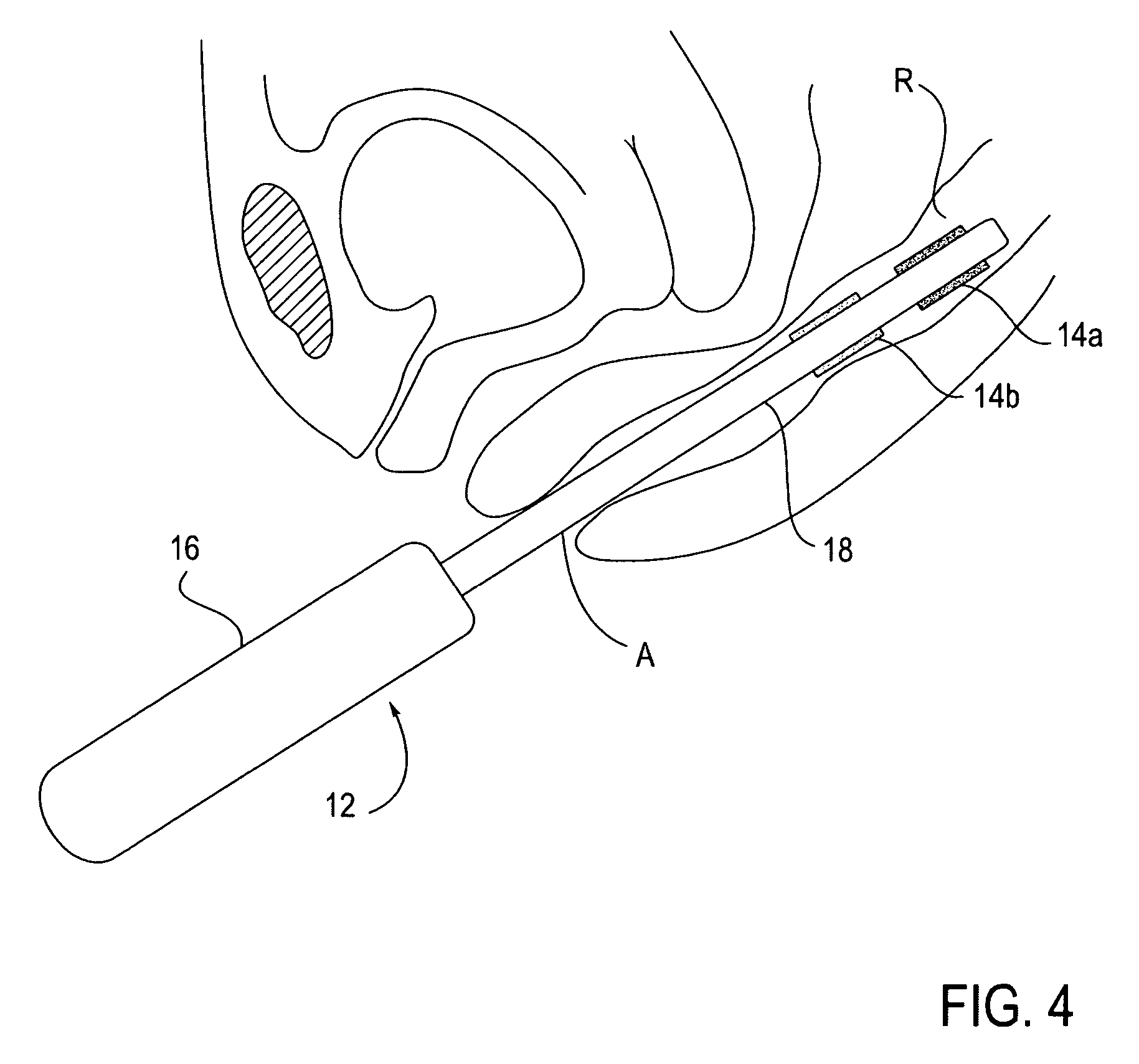 Devices and methods of screening for neoplastic and inflammatory disease