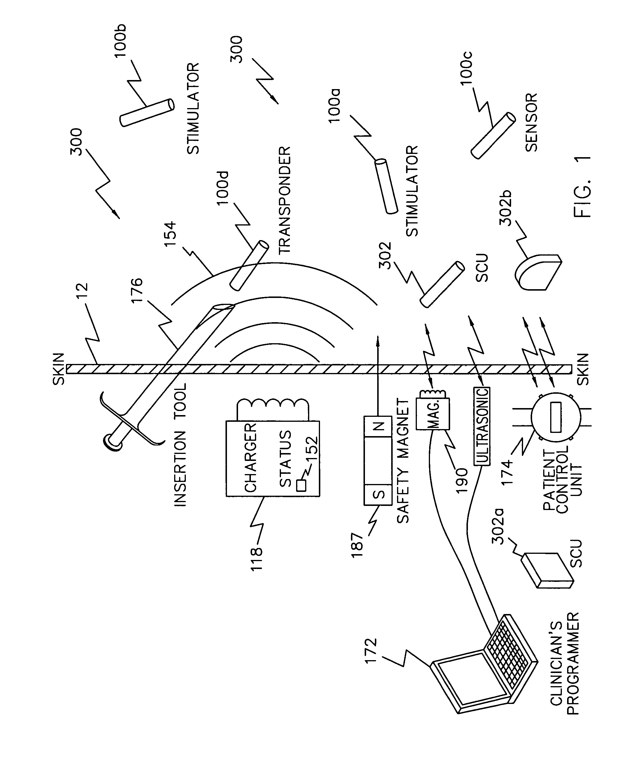 System of implantable ultrasonic emitters for preventing restenosis following a stent procedure