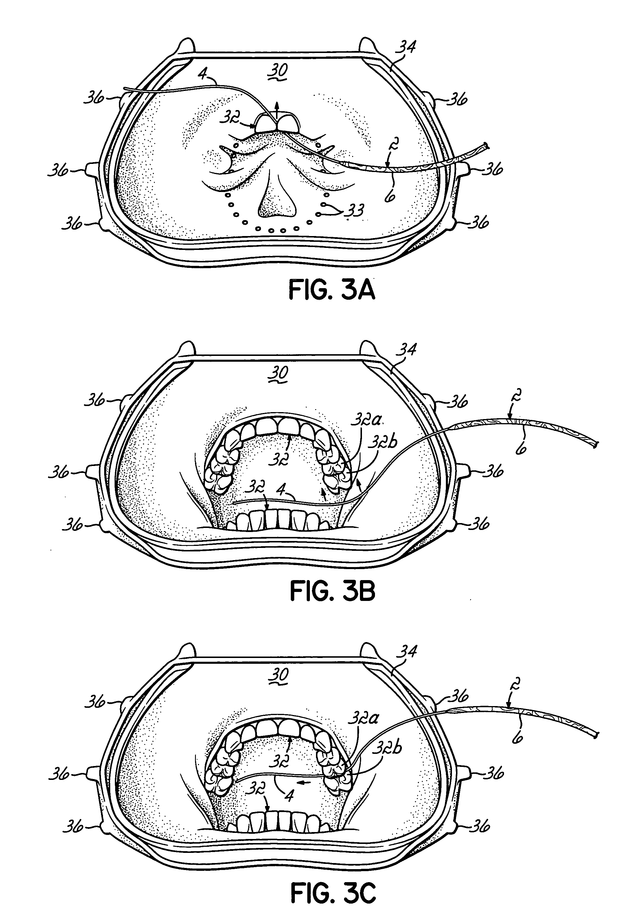 Clamping cord with polymeric wedge component, and method of affixation
