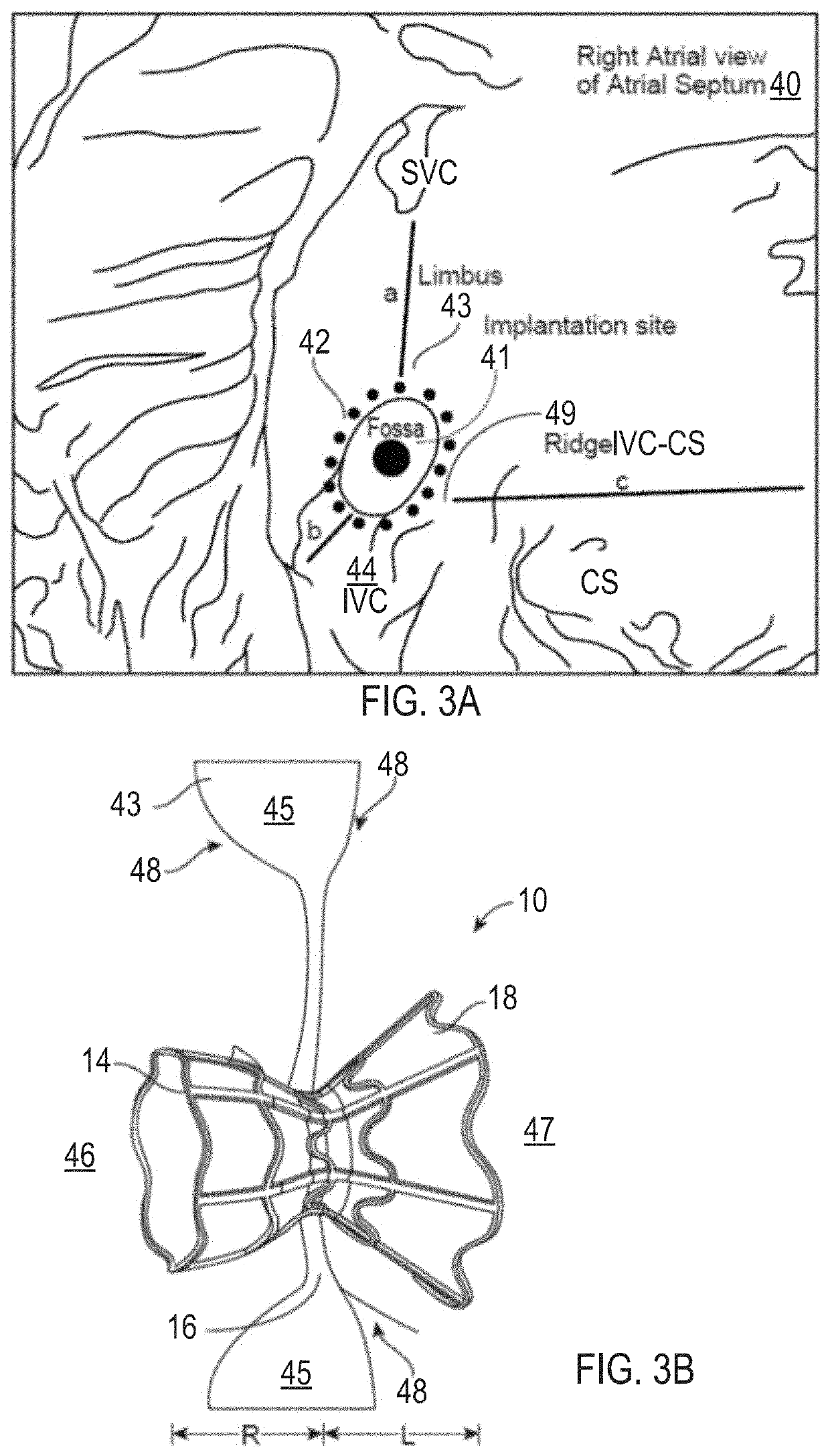 Asymmetric shunt for redistributing atrial blood volume