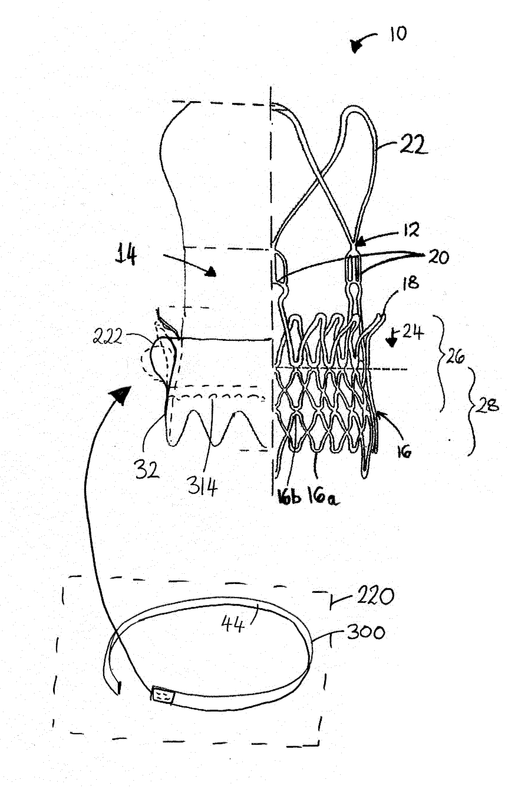 Prosthesis seals and methods for sealing an expandable prosthesis