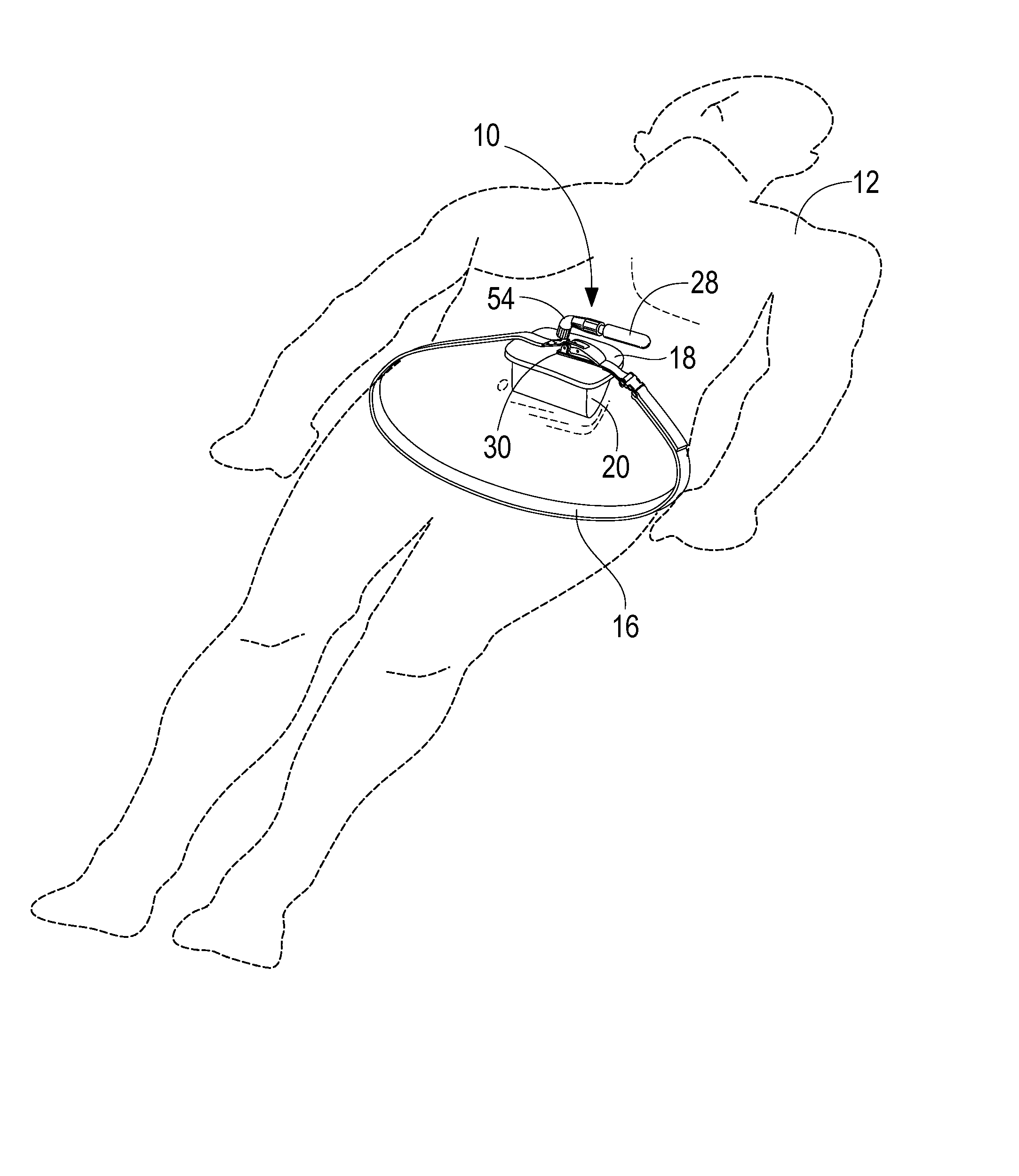 Portable pneumatic abdominal aortic tourniquet with supplemental tensioning means