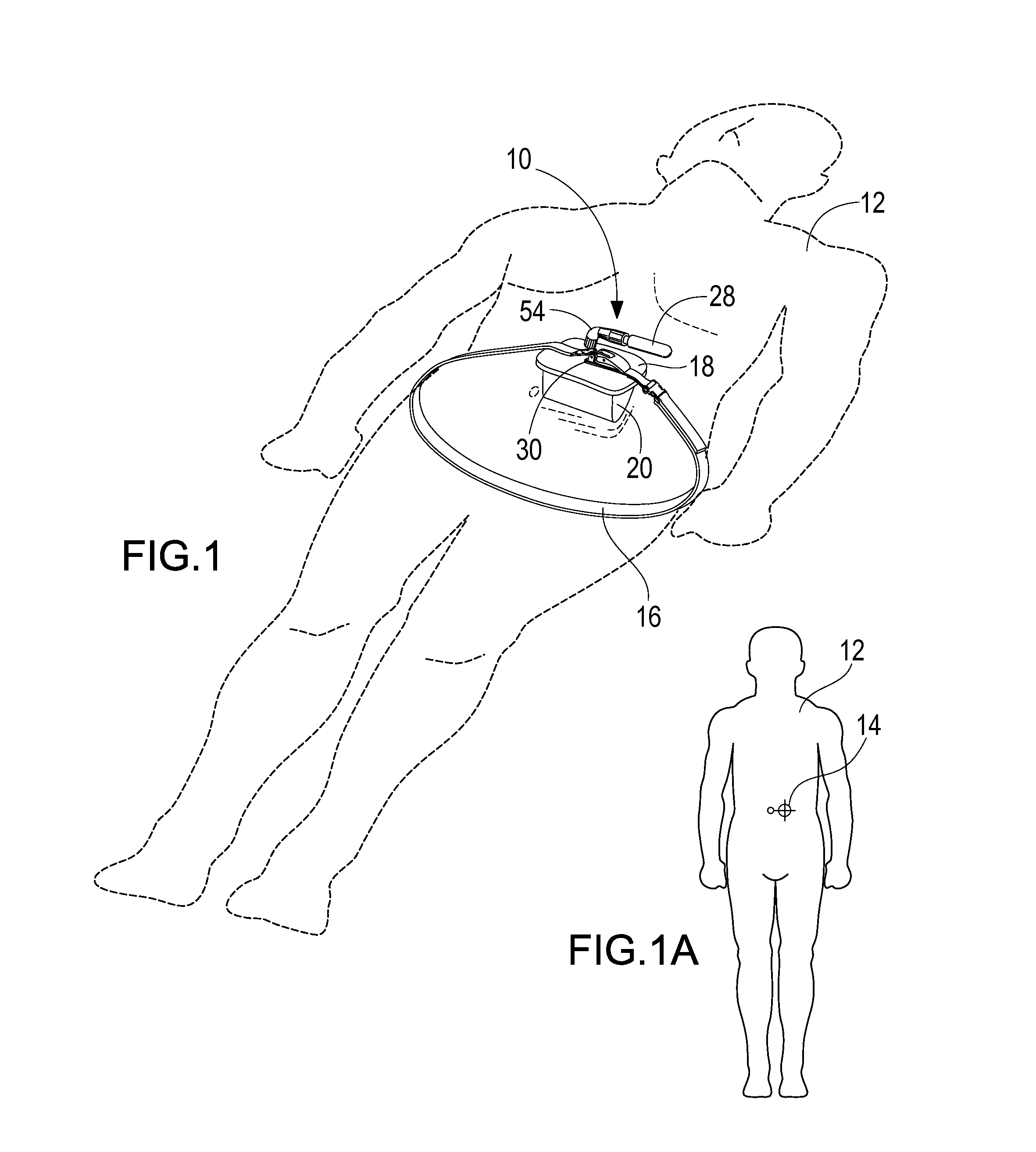 Portable pneumatic abdominal aortic tourniquet with supplemental tensioning means