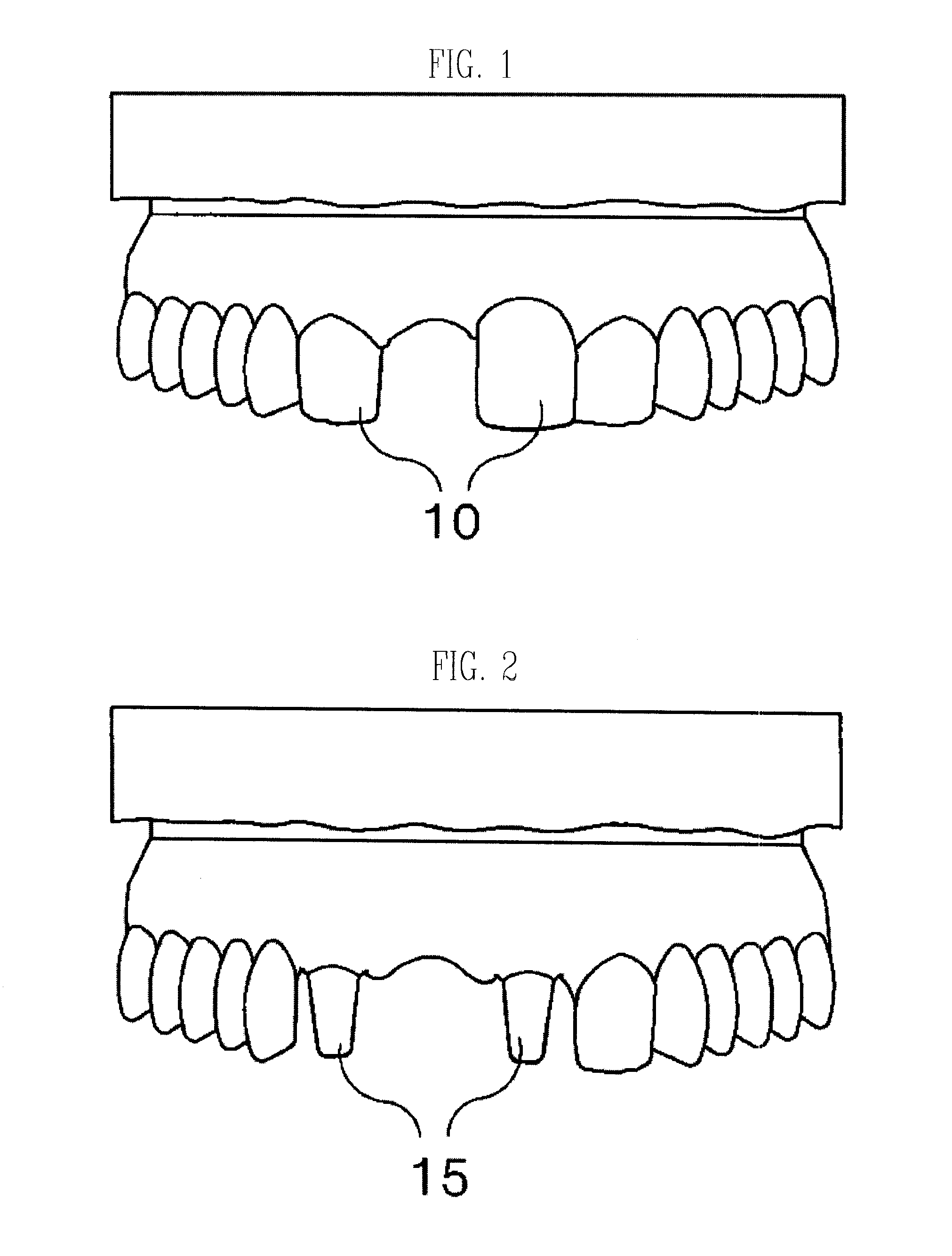 Temporary tooth bridge using veneer shell plate