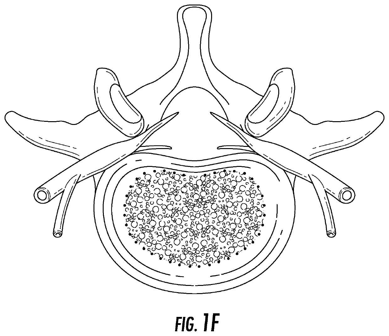 Device and method for correcting spinal deformities in patients