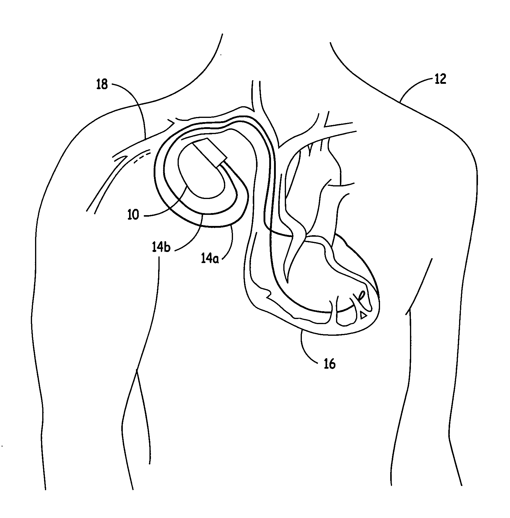 Lead-carried proximal electrode for quadripolar transthoracic impedance monitoring