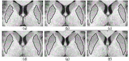 Interactive segmentation method applied to magnetic resonance image putamen