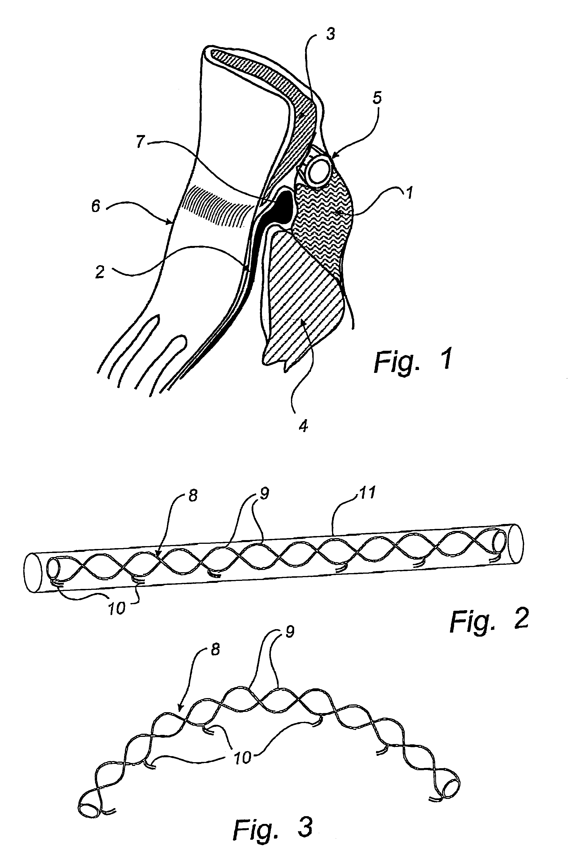 Method and device for treatment of mitral insufficiency