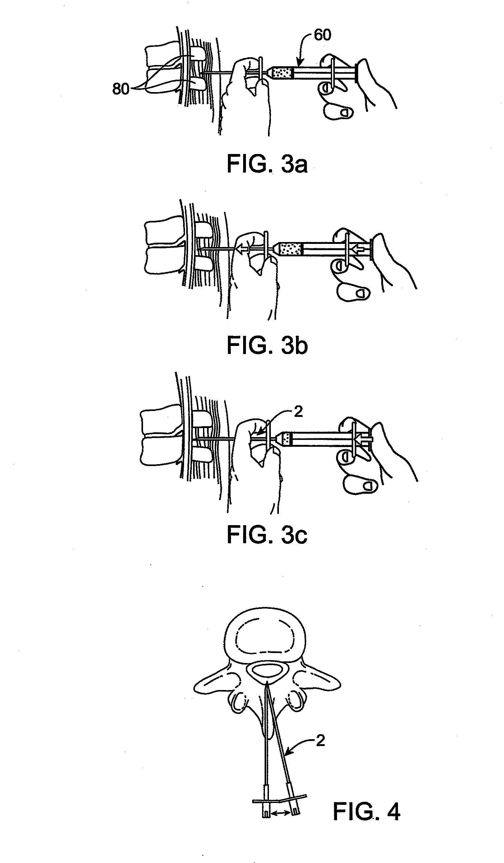 Devices and methods for tissue modification