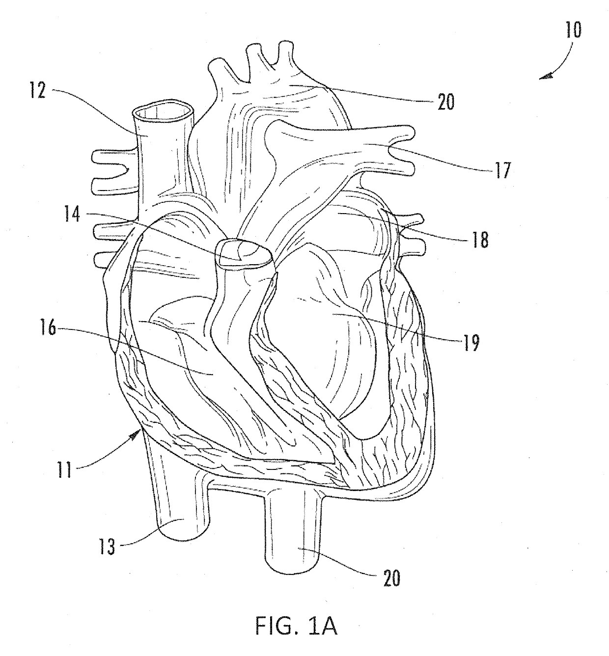 Systems and methods for selectively occluding the superior vena cava for treating heart conditions