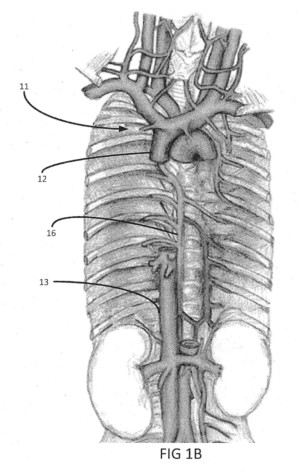 Systems and methods for selectively occluding the superior vena cava for treating heart conditions