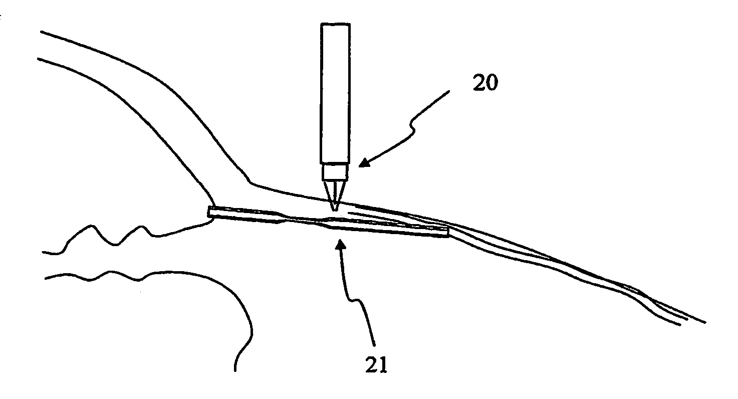 Apparatus and method for surgical bypass of aqueous humor