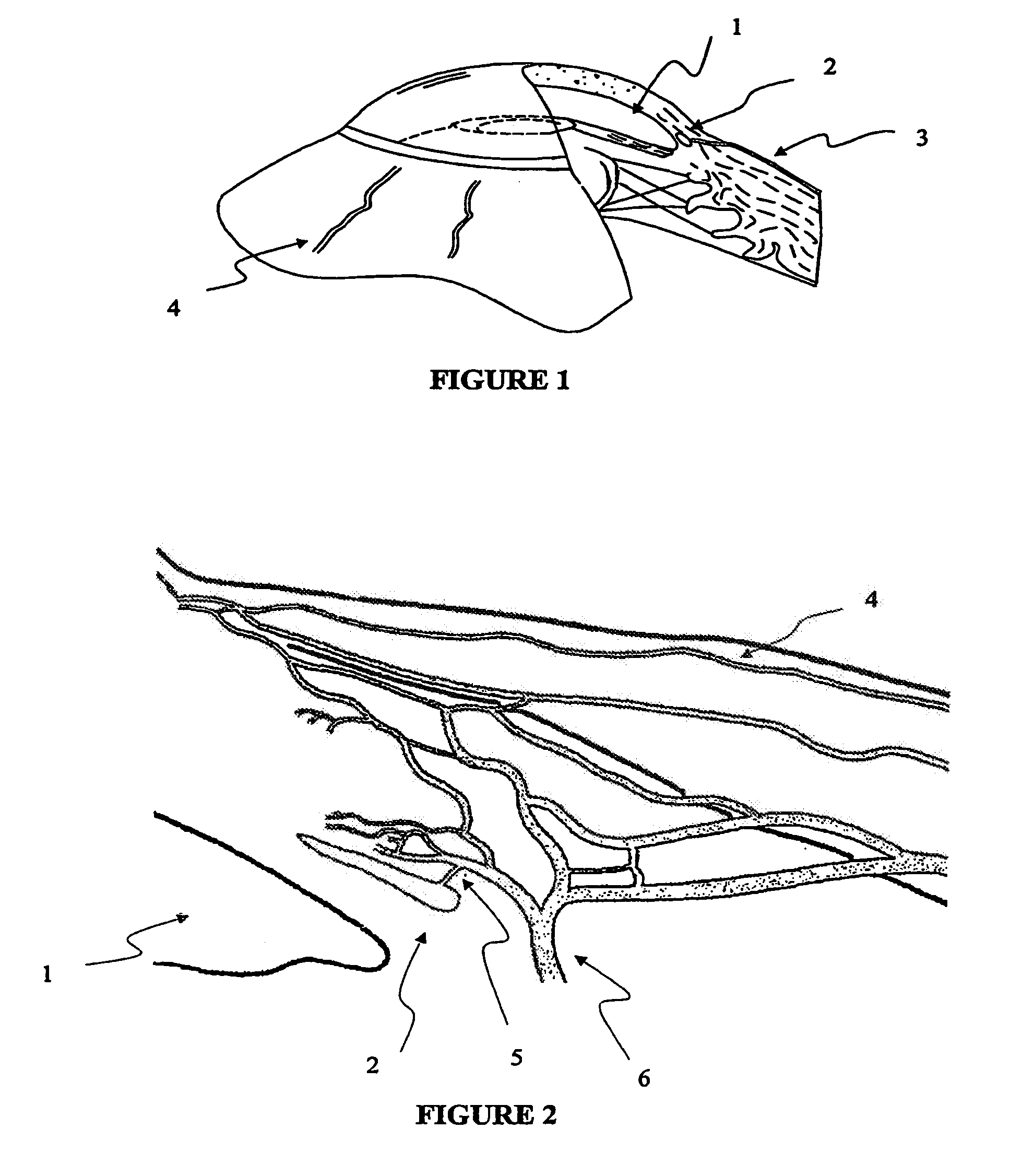 Apparatus and method for surgical bypass of aqueous humor