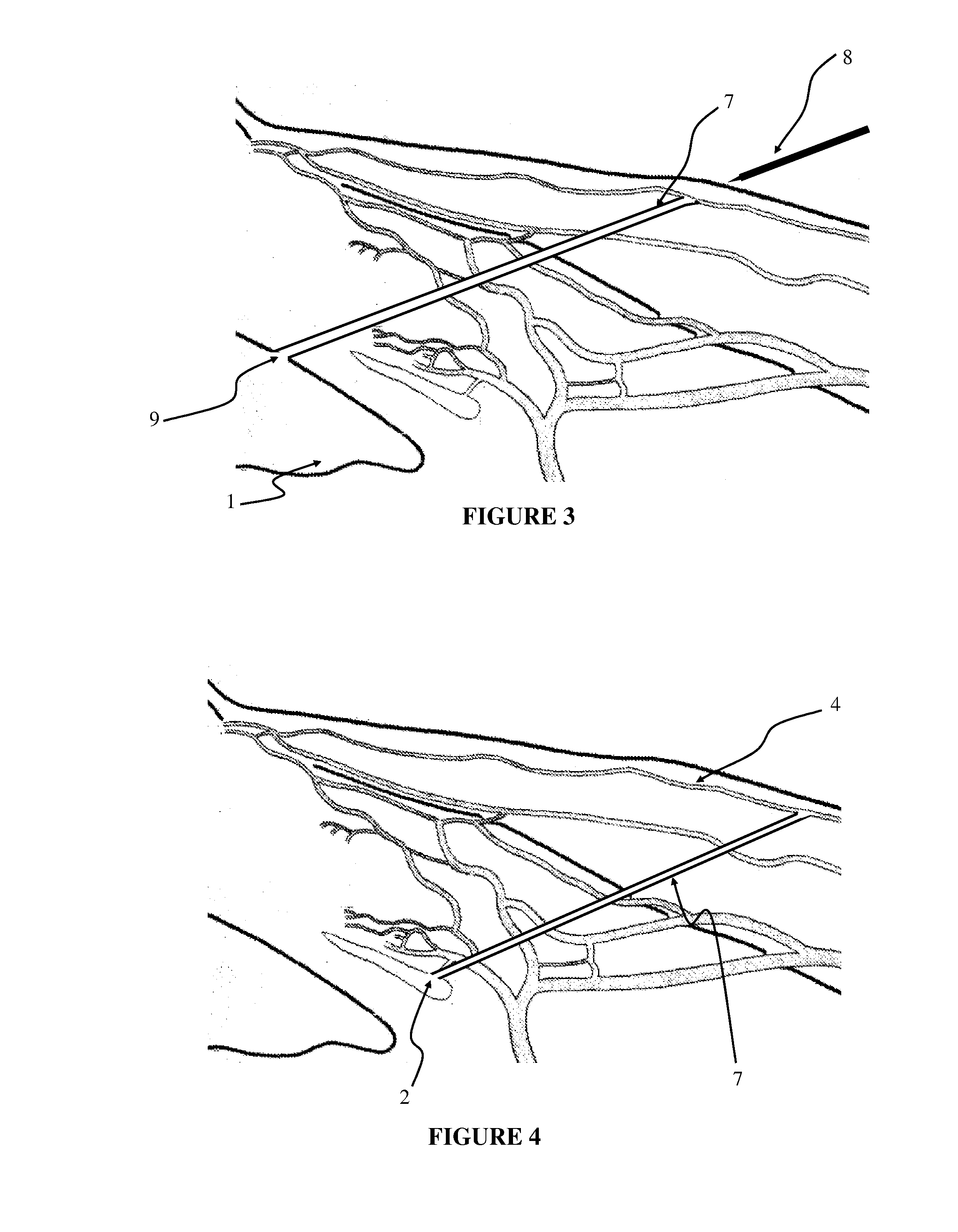 Apparatus and method for surgical bypass of aqueous humor