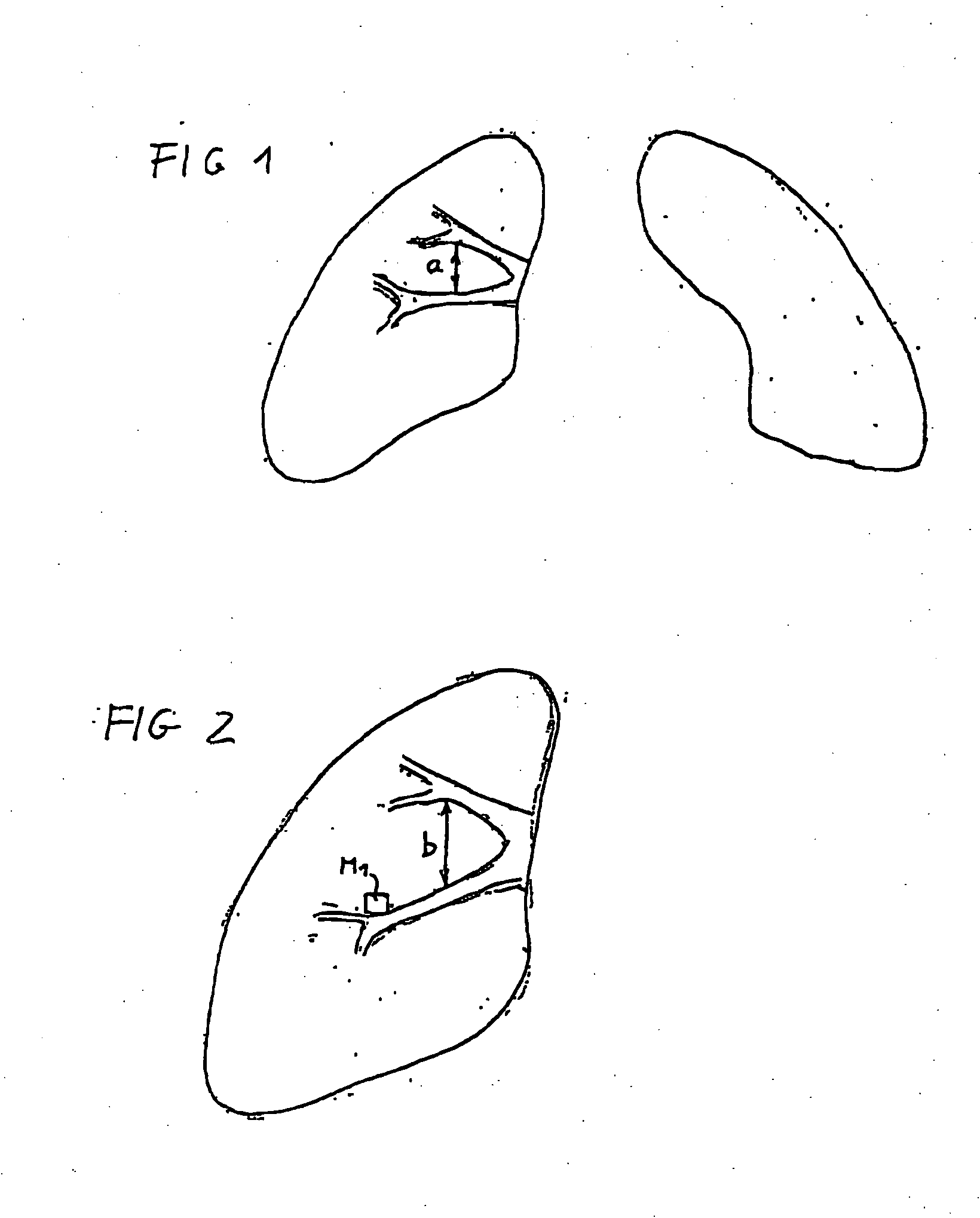 Method for Diagnosis of Functional Lung Illnesses