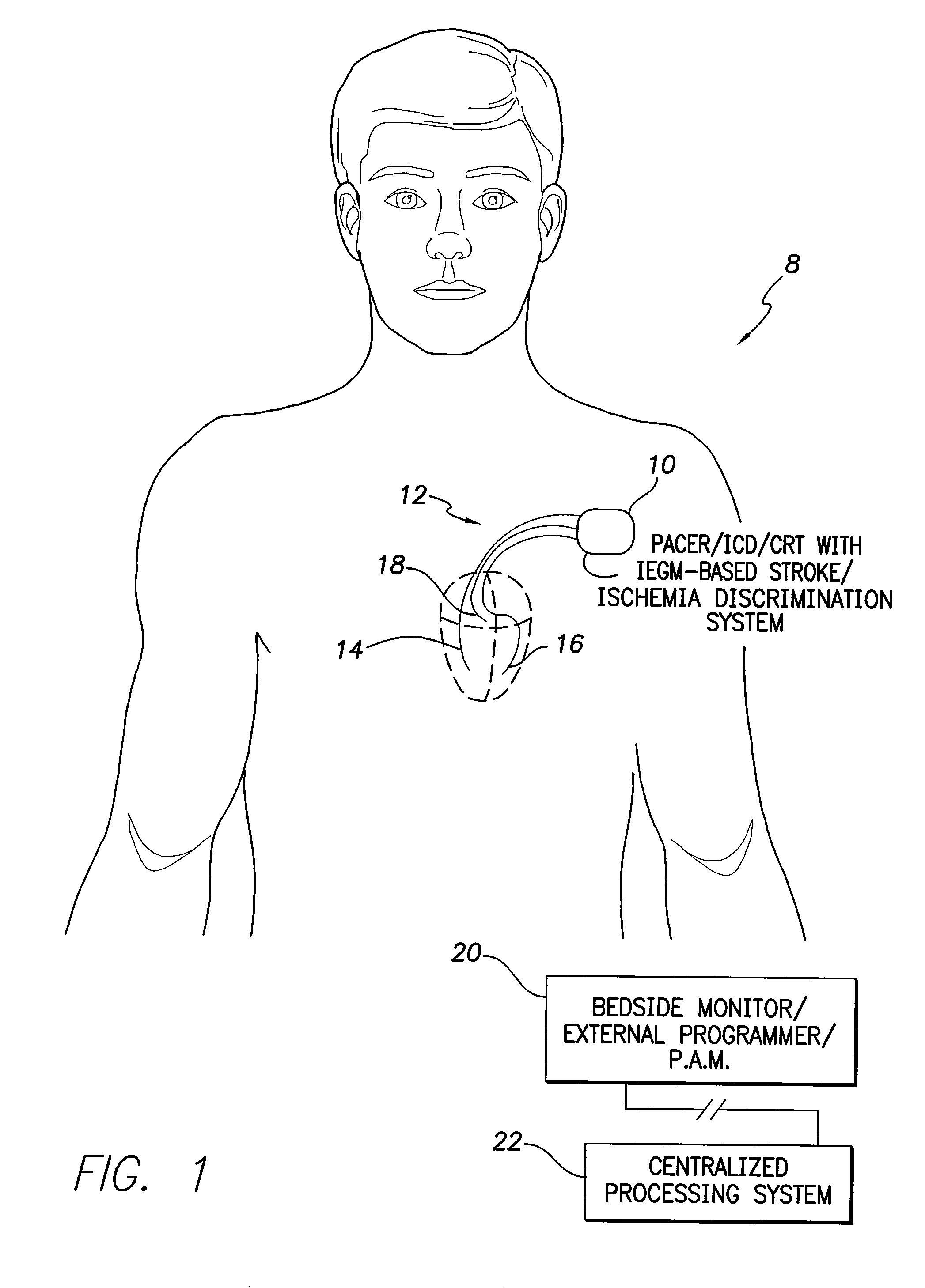 Systems and methods for use by implantable medical devices for detecting and discriminating stroke and cardiac ischemia using electrocardiac signals
