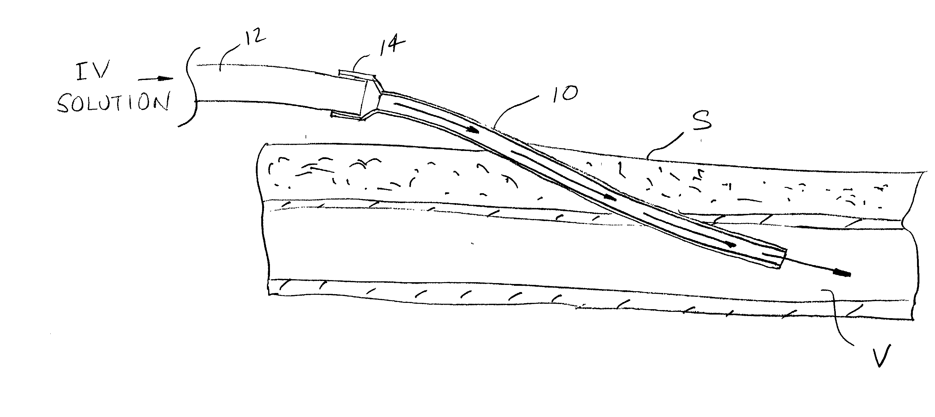 Methods and kits for for locking and and disinfecting implanted catheters