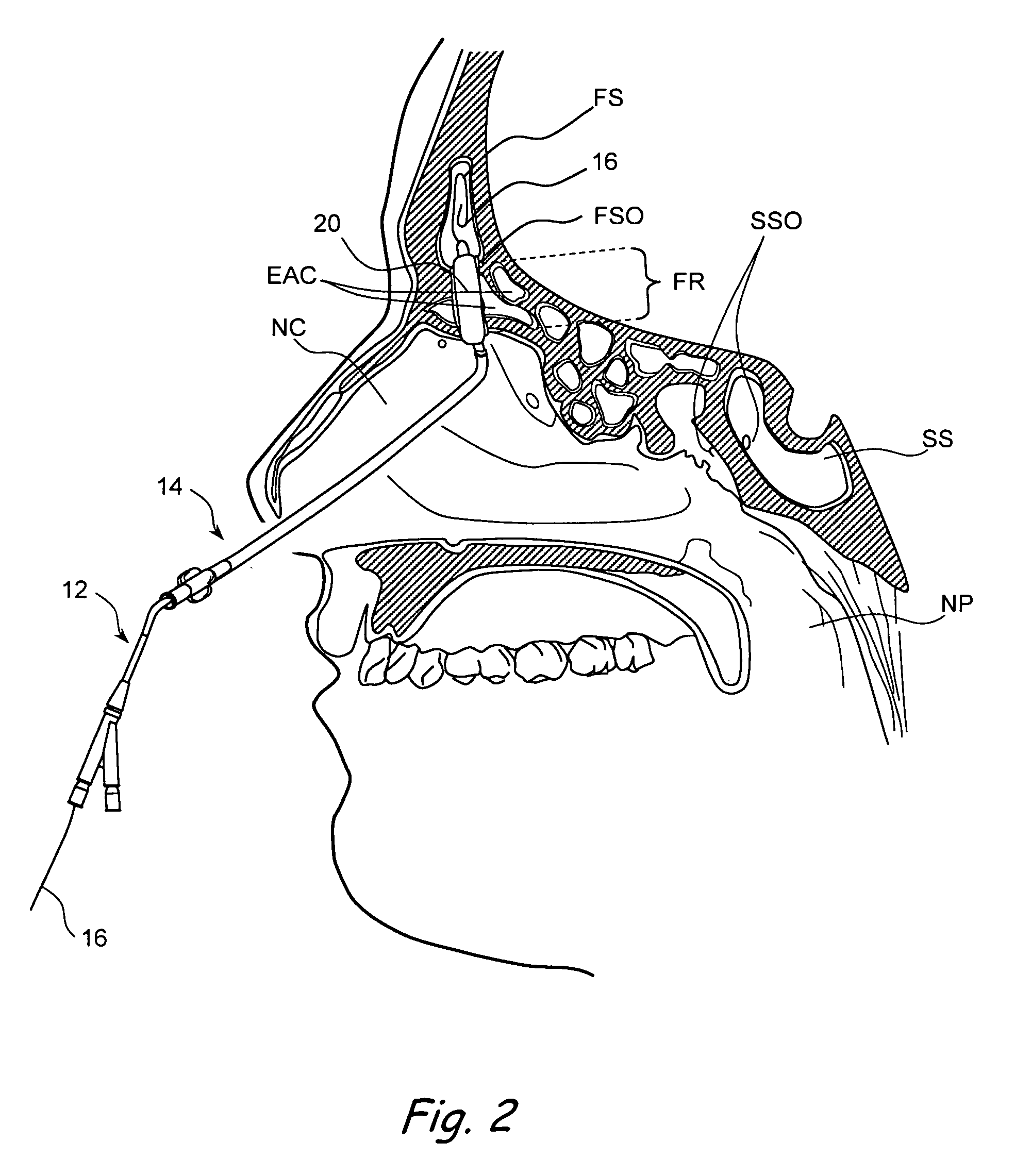 Devices, systems and methods useable for treating frontal sinusitis