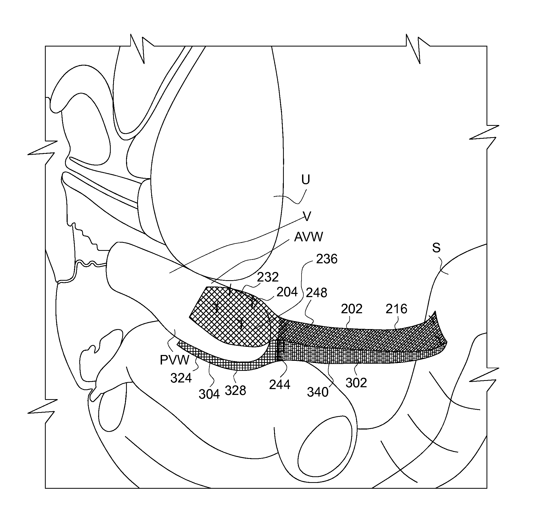Medical device and method of delivering the medical device