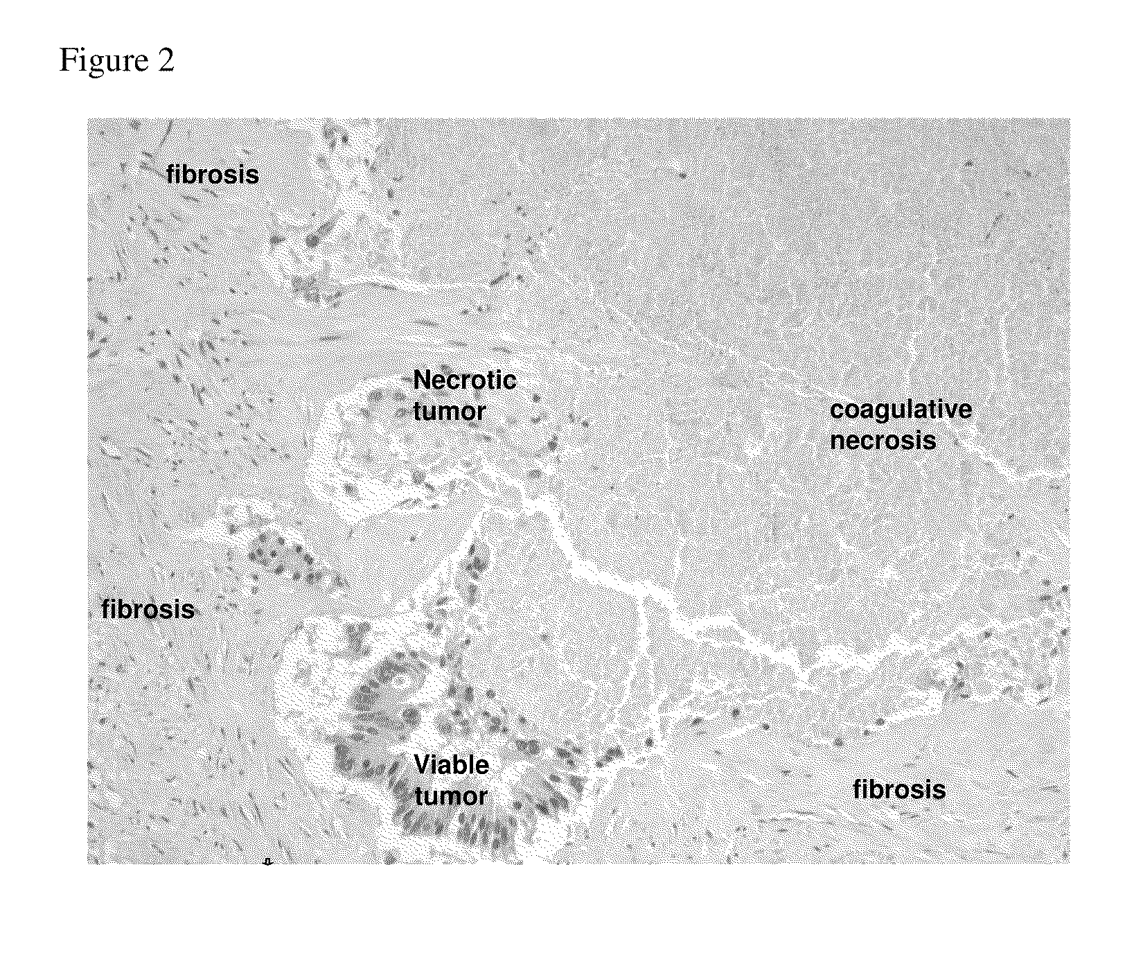 Methods and compositions for liquidation of tumors