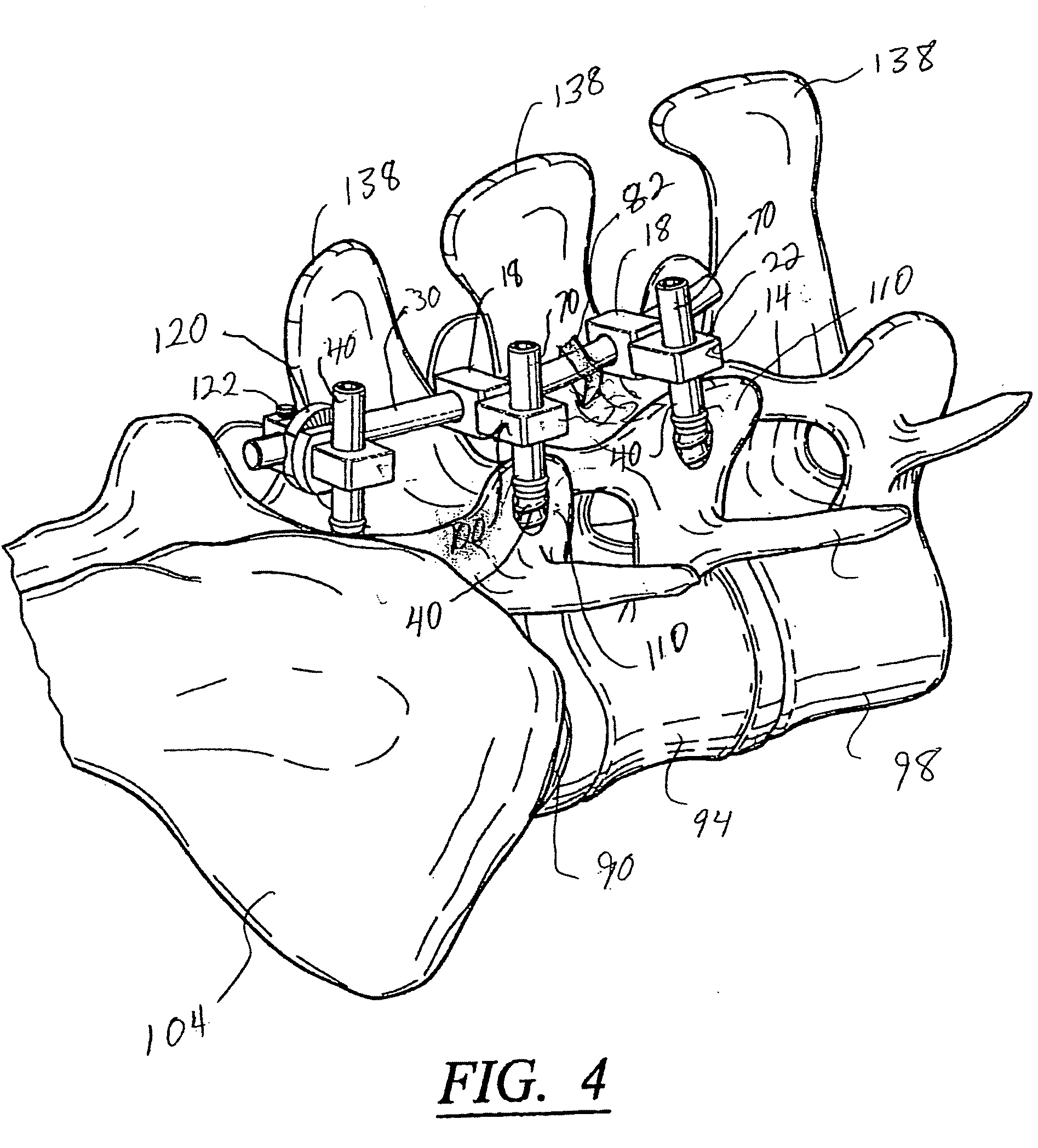 Artificial facet joint and method