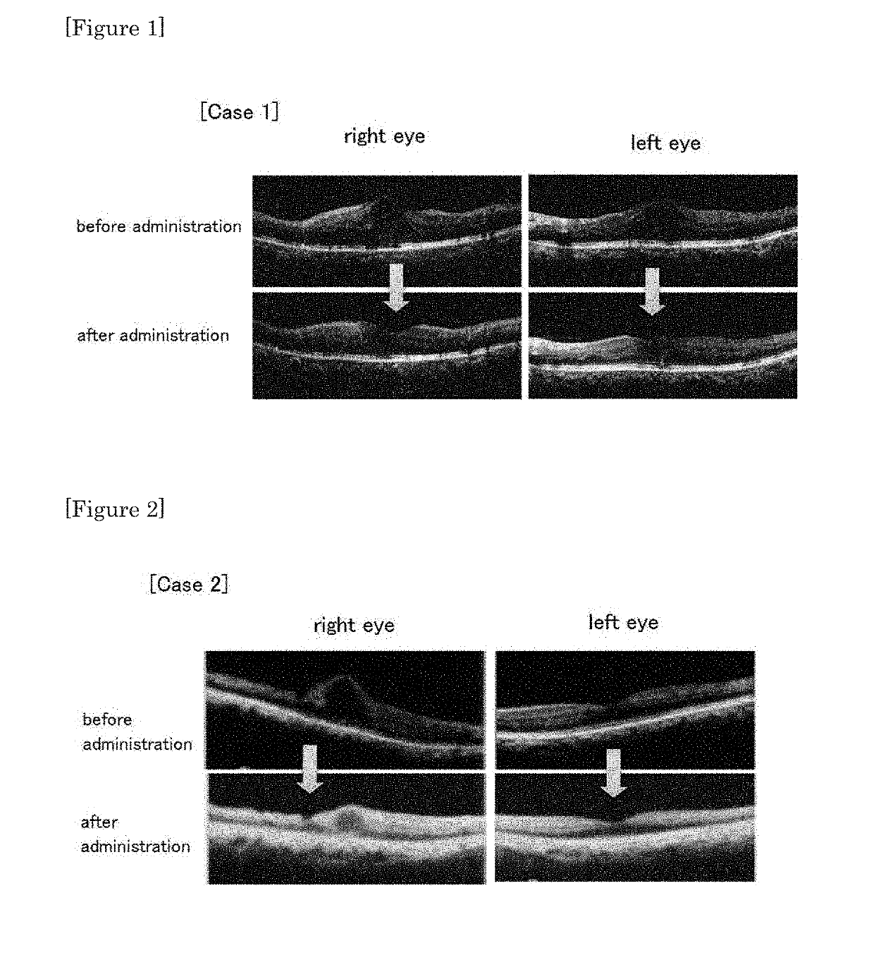 Agent for treating retinopathy