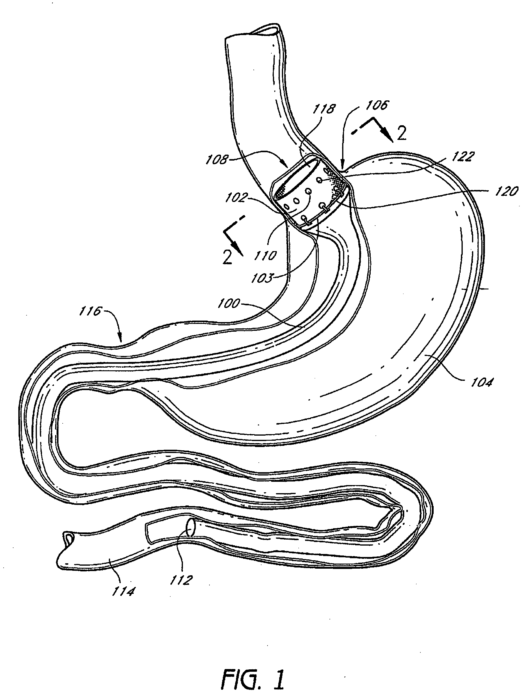 Devices and methods for endolumenal gastrointestinal bypass