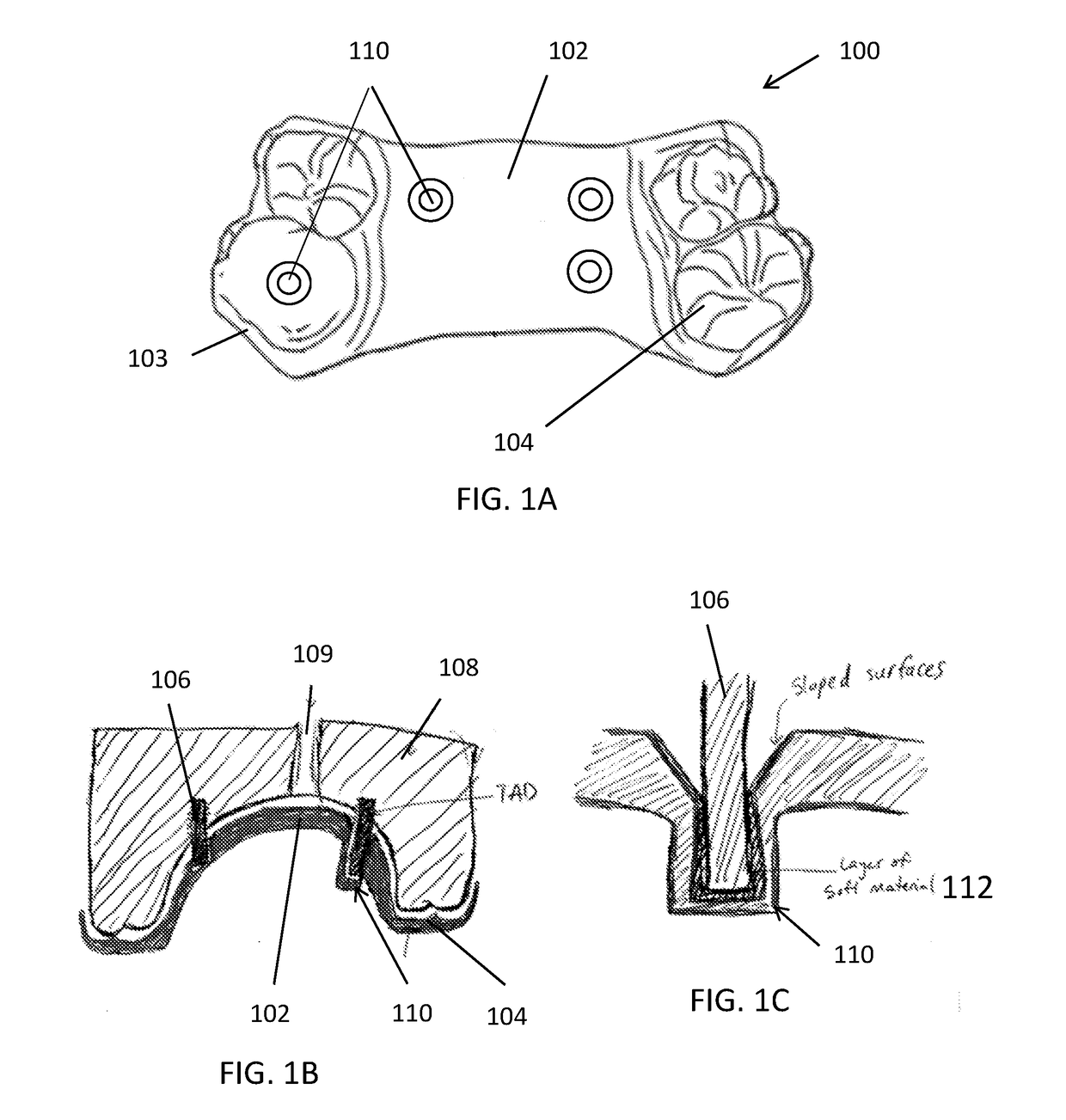 Palatal expander with skeletal anchorage devices