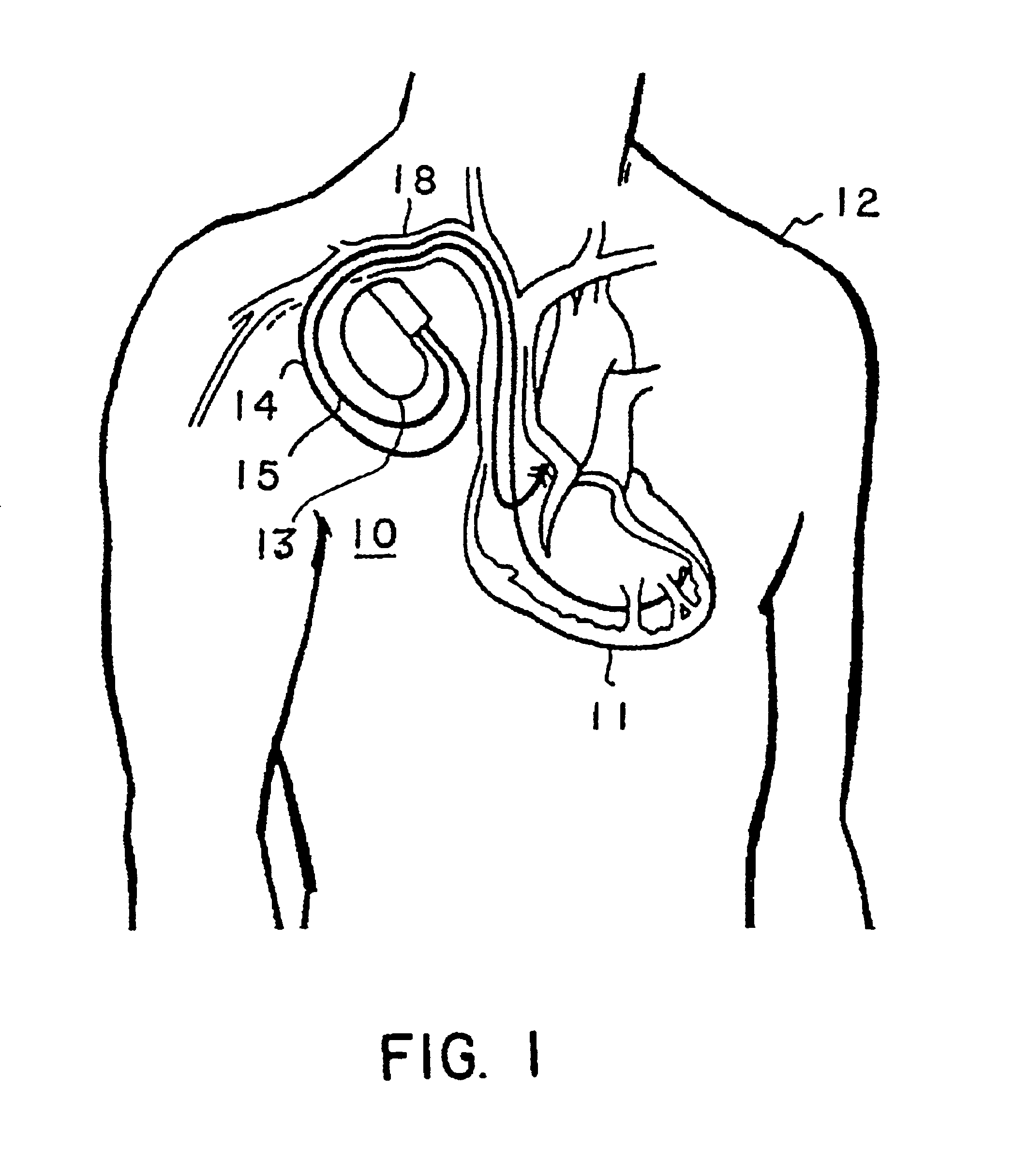 Methods and apparatus for detection and treatment of syncope