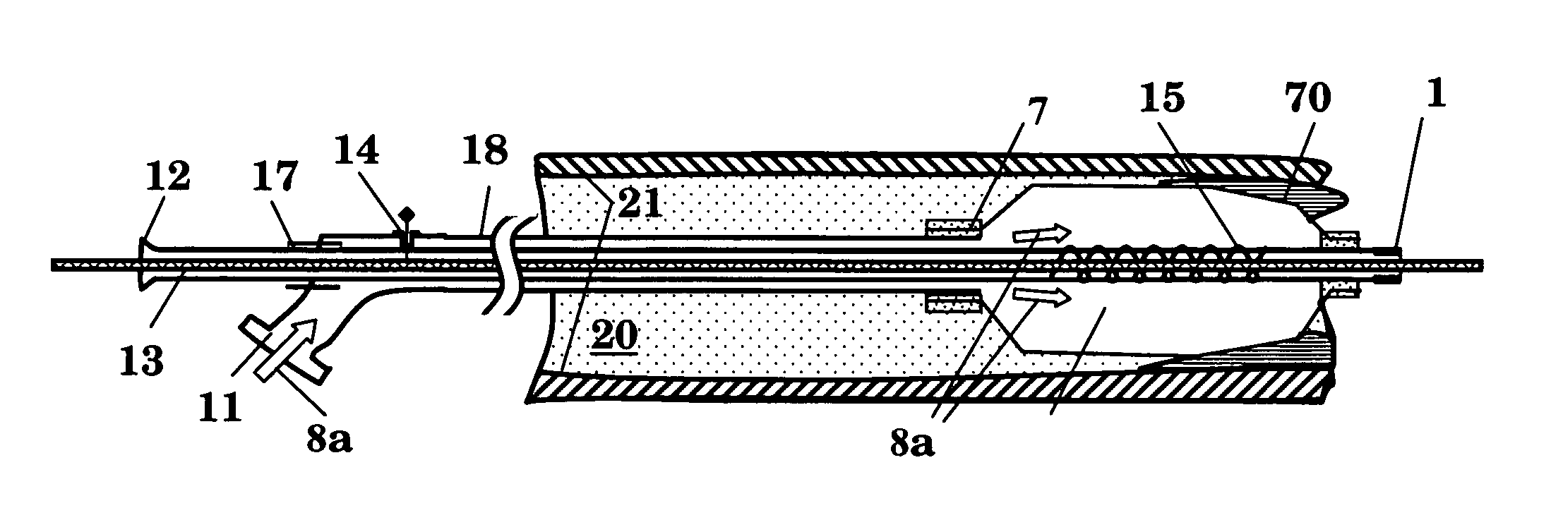 Balloon catheter system for treating vascular occlusions