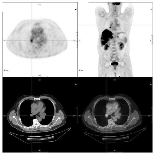 Integrated ResNet-NRC method for dividing sample space based on lung tumor image