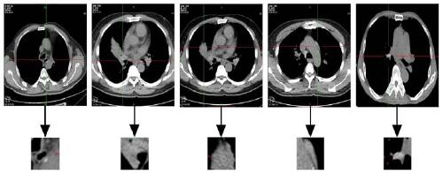 Integrated ResNet-NRC method for dividing sample space based on lung tumor image