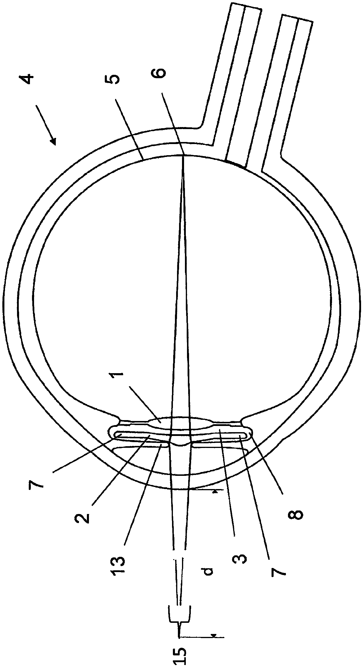 Two-stage intraocular lens with magnifying coaxial optic