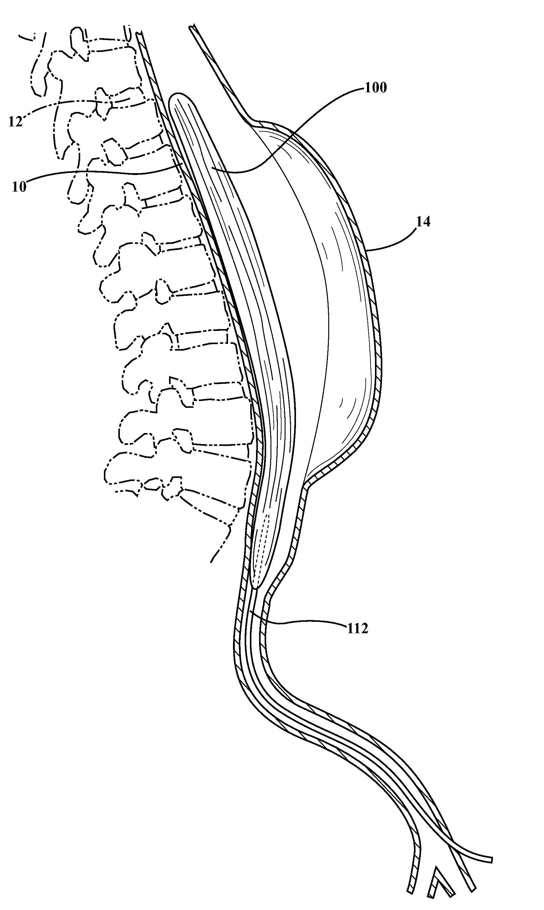 Lumbar ostia occlusion devices and methods of deploying the same