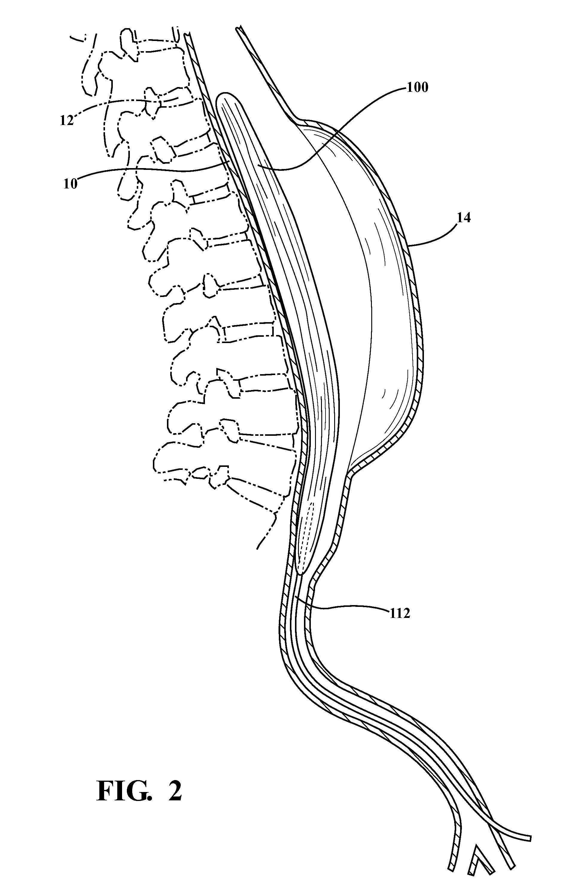 Lumbar ostia occlusion devices and methods of deploying the same