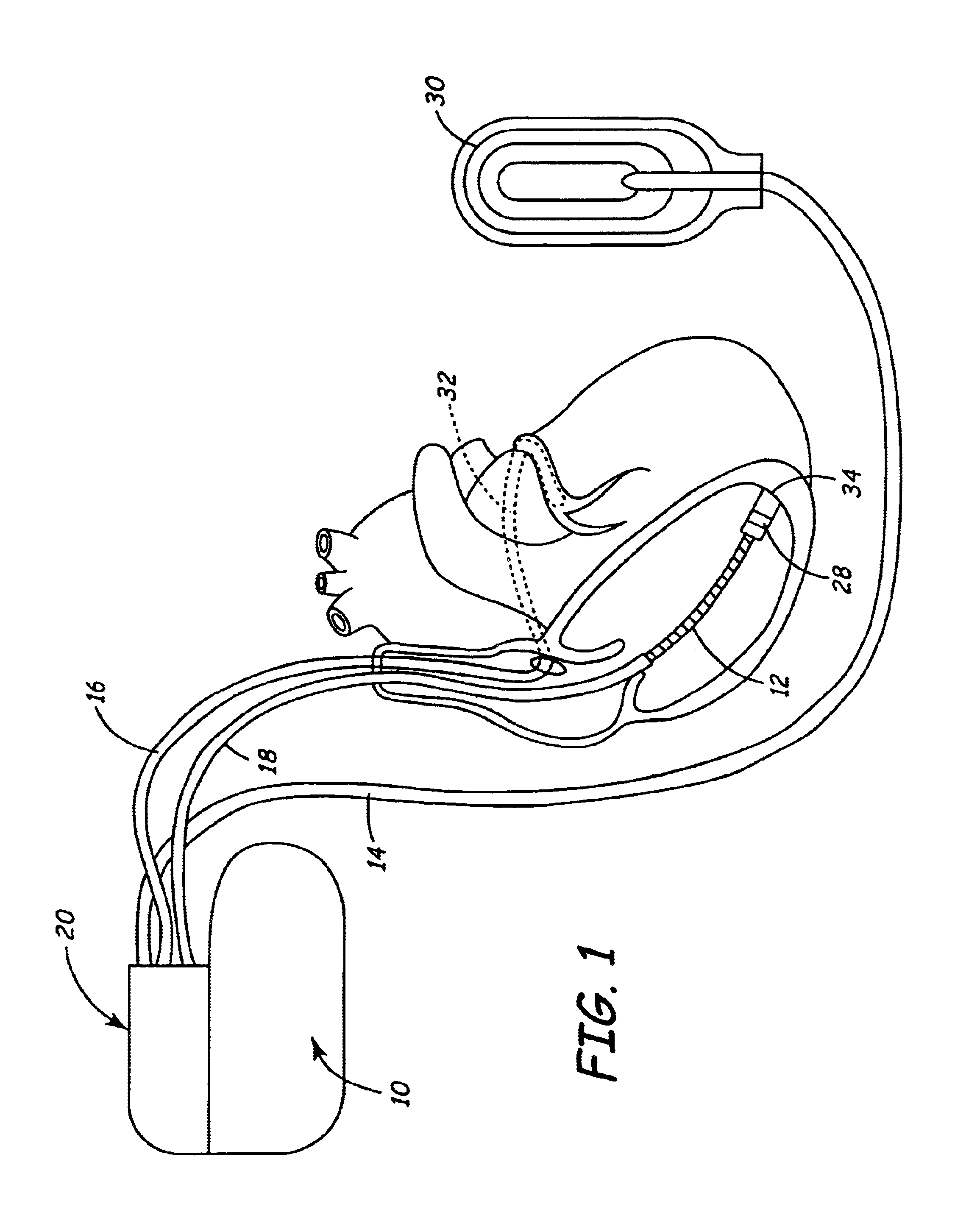 Implantable medical device having flat electrolytic capacitor fabricated with laser welded anode sheets