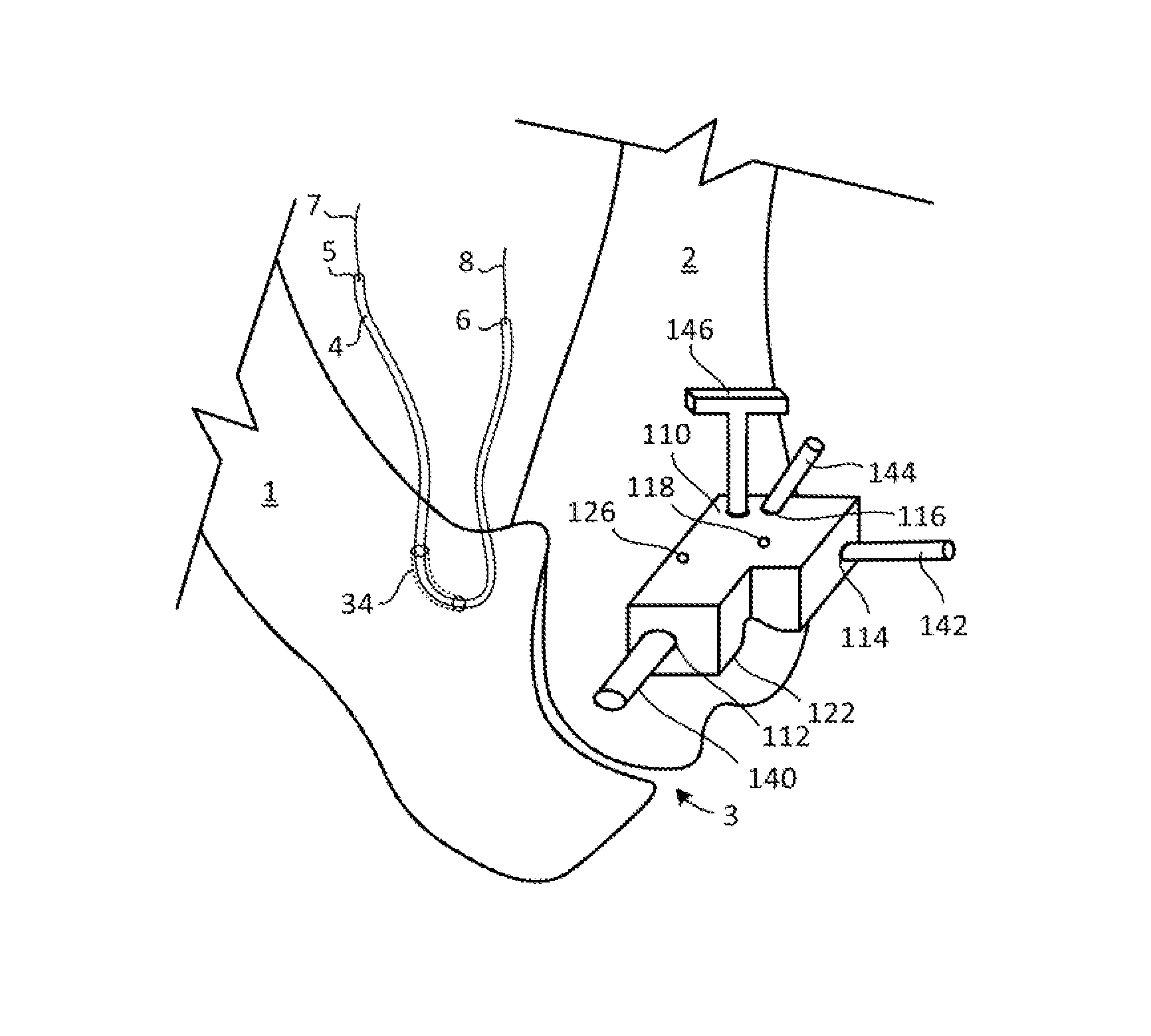 Ligament reconstruction system