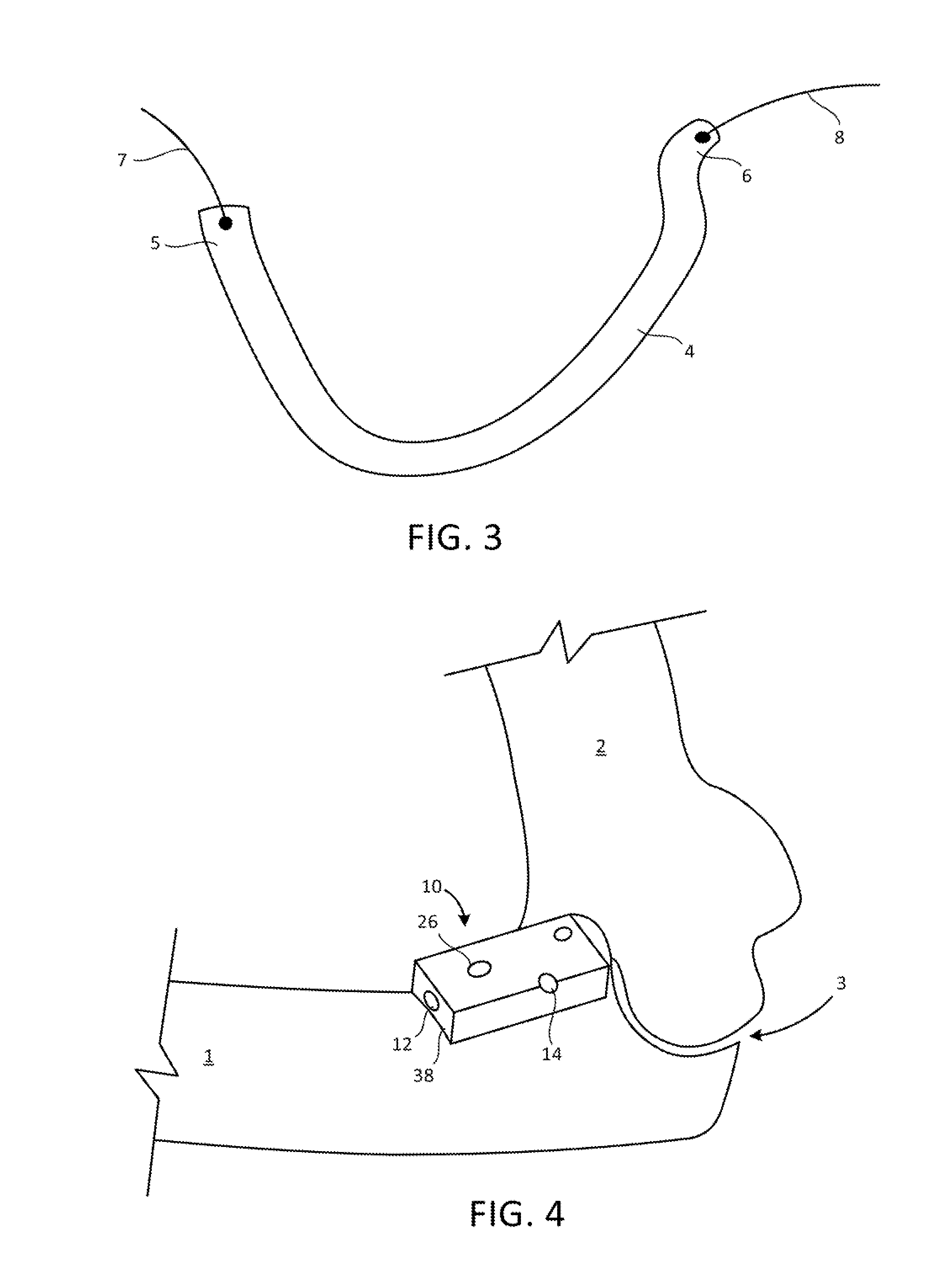 Ligament reconstruction system