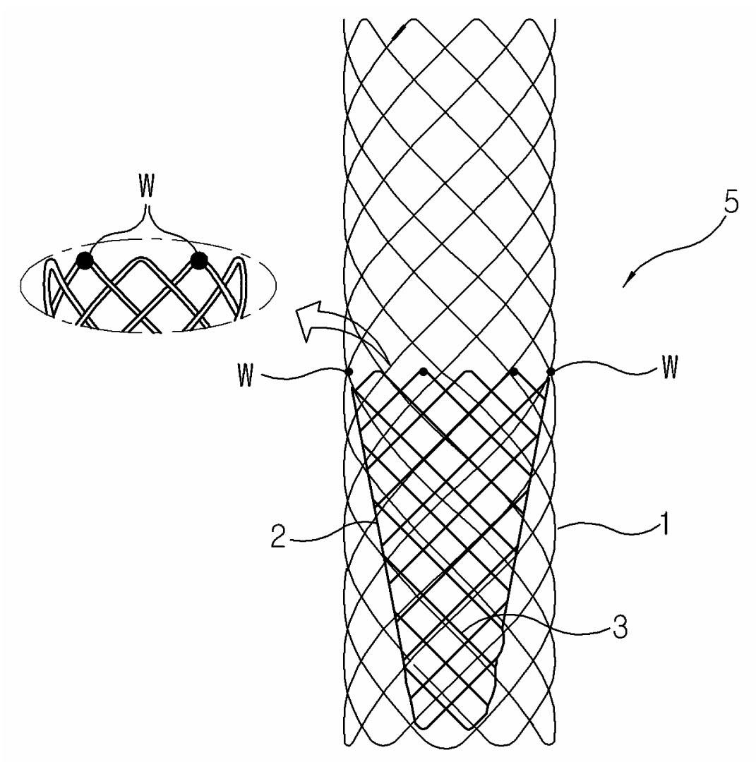 Stent