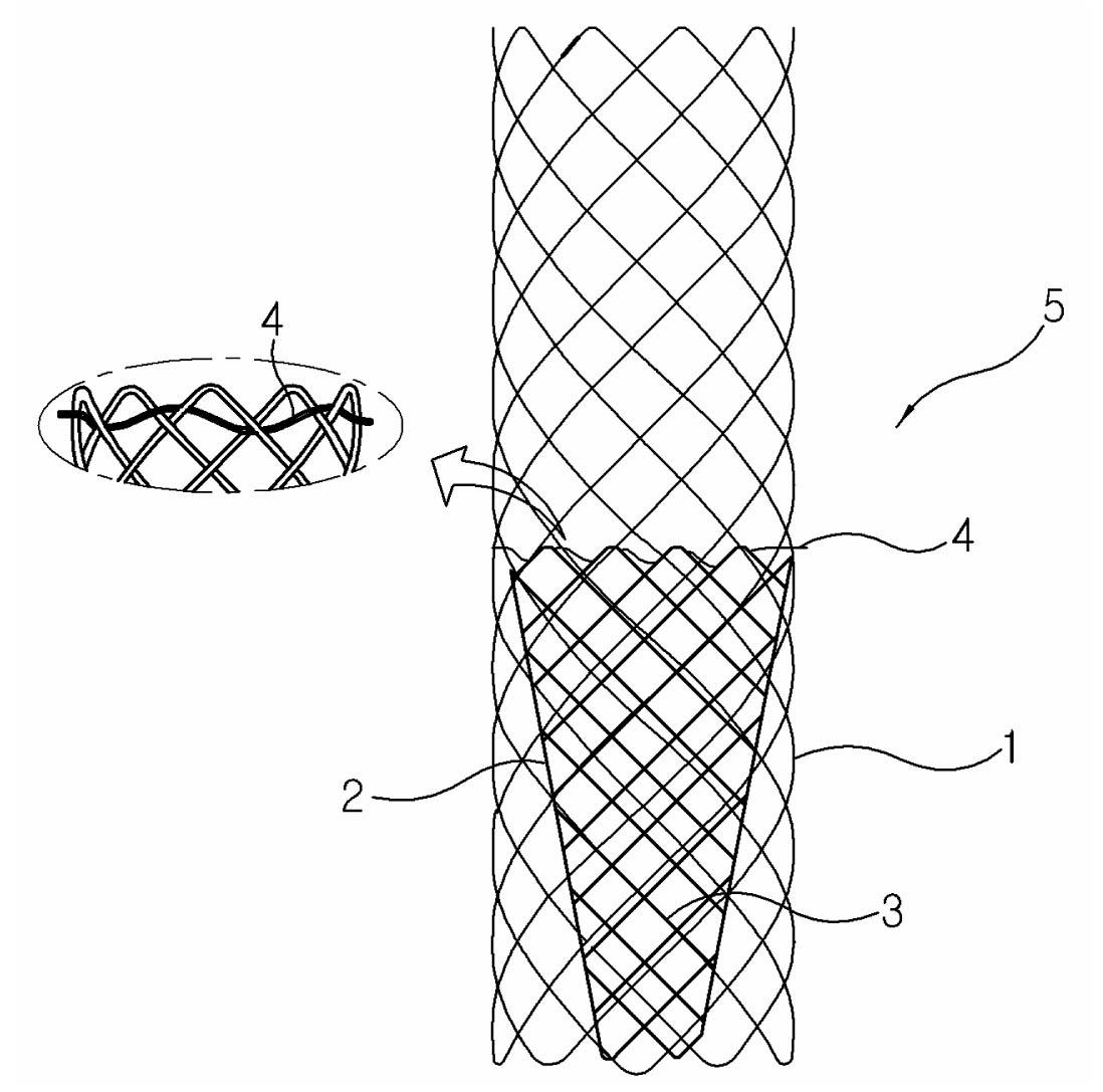 Stent