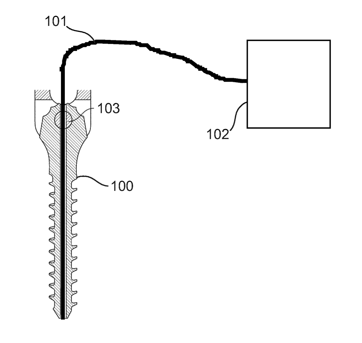 System for implanting in bone tissue