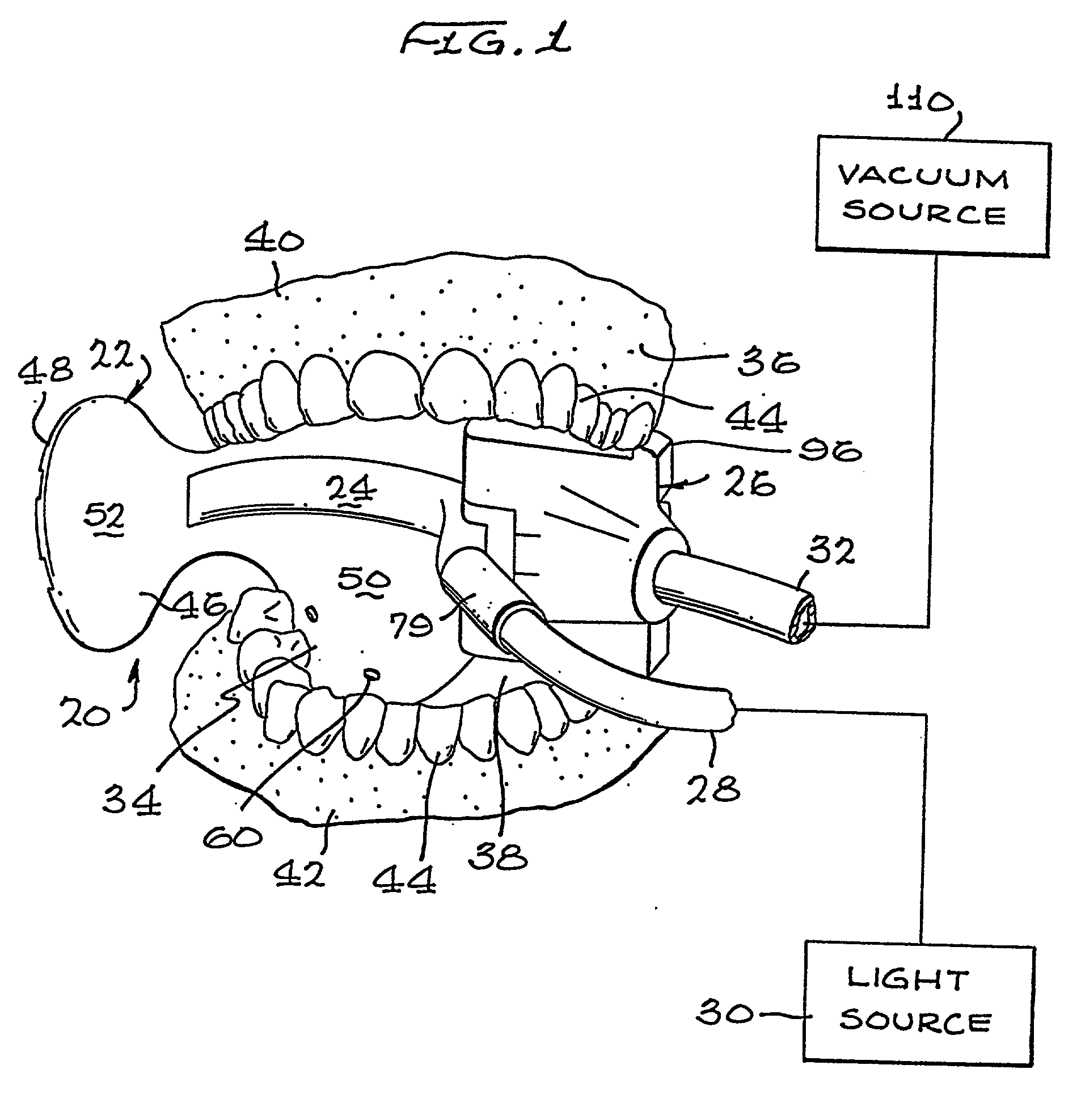 Intraoral device