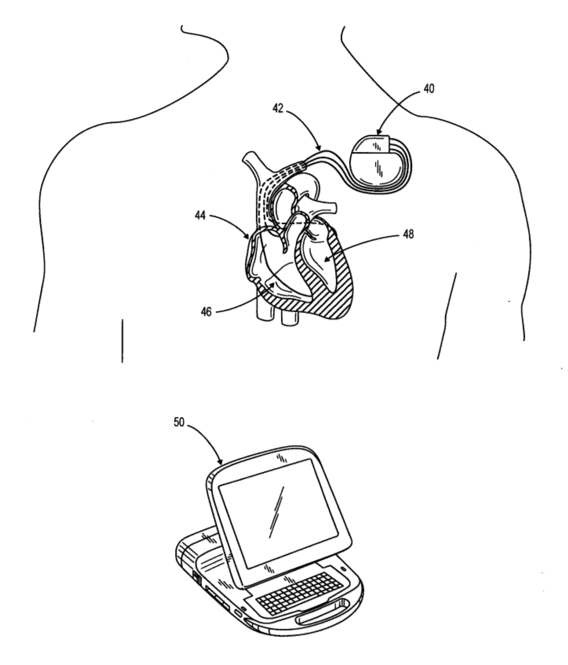 Method of Defining Continuous Heart Rate vs AV Delay Values and Sensed to Paced AV Delay Offset in Patients Undergoing Cardiac Resynchronization Therapy