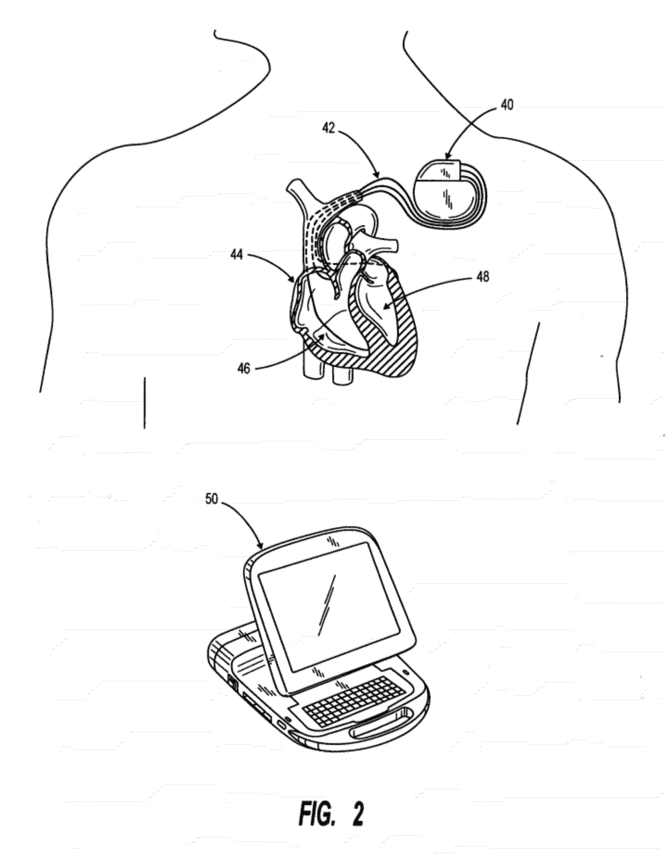 Method of Defining Continuous Heart Rate vs AV Delay Values and Sensed to Paced AV Delay Offset in Patients Undergoing Cardiac Resynchronization Therapy