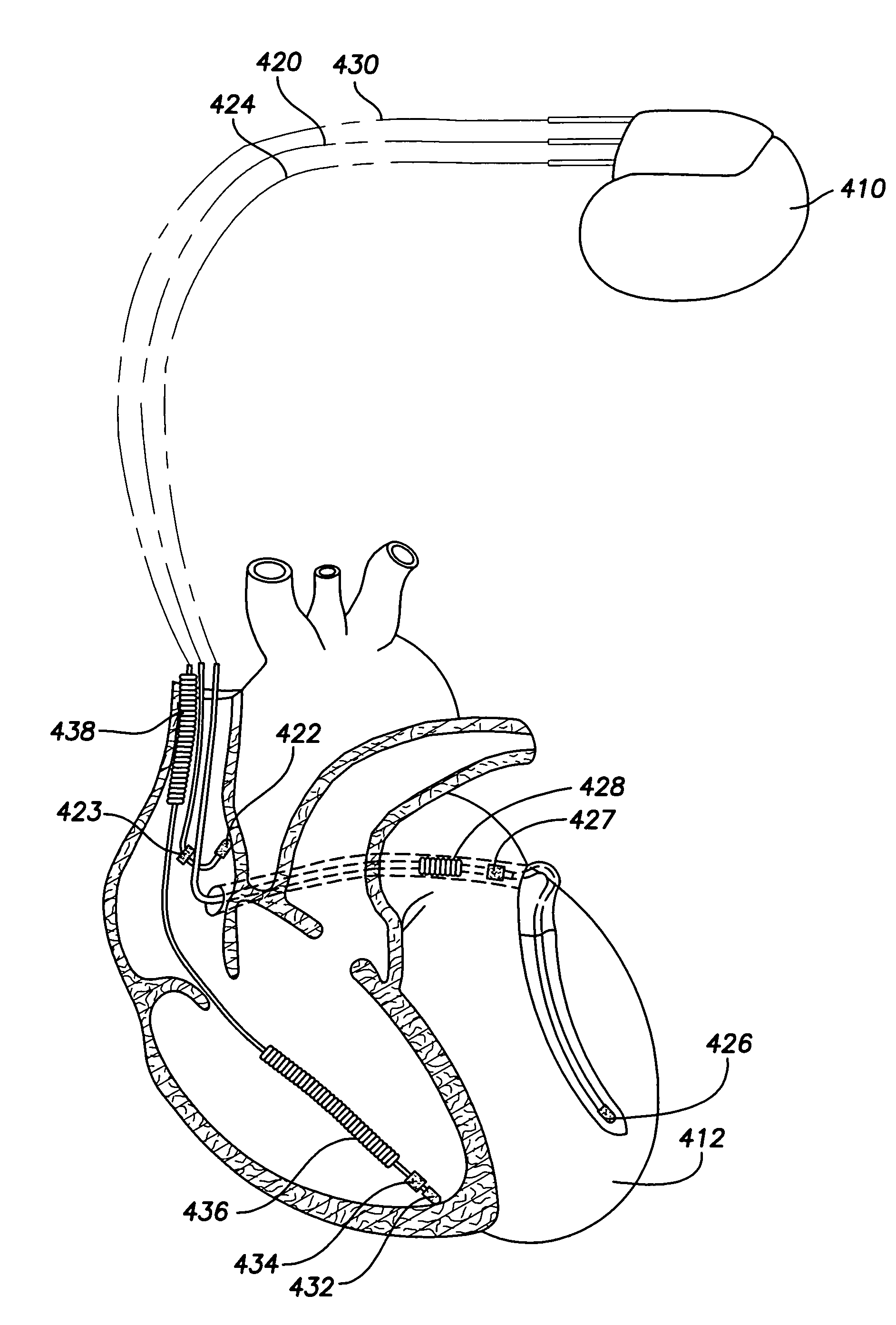 System and method for determining preferred atrioventricular pacing delay values based on intracardiac electrogram signals